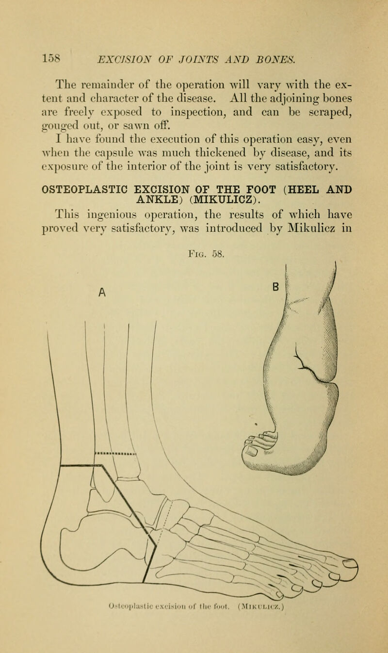The remainder of the operation will vary with the ex- tent and character of the disease. All the adjoining bones arc freely exposed to inspection, and can be scraped, gouged out, or sawn off. 1 have found the execution of this operation easy, even when the capsule was much thickened by disease, and its exposure of the interior of the joint is very satisfactory. OSTEOPLASTIC EXCISION OF THE FOOT (HEEL AND ANKLE) (MIKULICZ). This ingenious operation, the results of which have proved very satisfactory, was introduced by Mikulicz in Fig. 58.