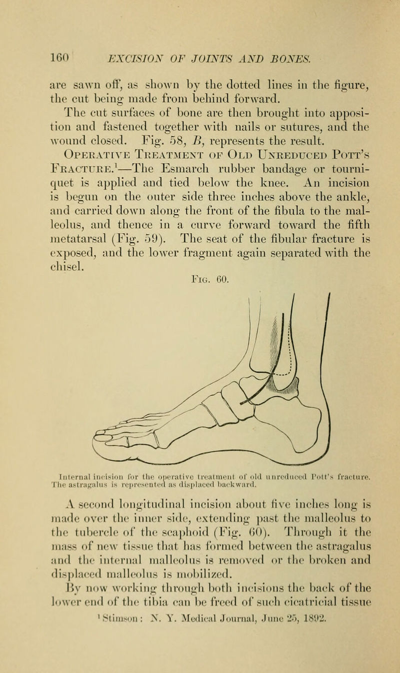 are sawn off, as shown by the dotted lines in the figure, the cut being made from behind forward. The cut surfaces of bone are then brought into apposi- tion and fastened together with nails or sutures, and the wound closed. Fig. 58, B, represents the result. Operative Treatment of Old Unreduced Pott's Fracture.1—The Esmarch rubber bandage or tourni- quet is applied and tied below the knee. An incision is begun on the outer side three inches above the ankle, and carried down along the front of the fibula to the mal- leolus, and thence in a curve forward toward the fifth metatarsal (Fig. .VJ). The seat of the fibular fracture is exposed, and the lower fragment again separated with the chisel. Fig. 60. [nternal incision for the operative treatment of old unreduced Pott's fracture. 11m astragalus is represented as displaced backward, A second longitudinal incision about five inches lone is made over the inner side, extending past the malleolus to the tubercle of the scaphoid (Fig. 60). Through it the mass of new tissue that has formed between the astragalus and the internal malleolus is removed or the broken and displaced malleolus is mobilized. By now working through both incisions the hack of the lower end of the til>i:i can be WnA of sncli cicatricial tissue 'Stimson; N. Y. Medical Journal, June 25, 1892.