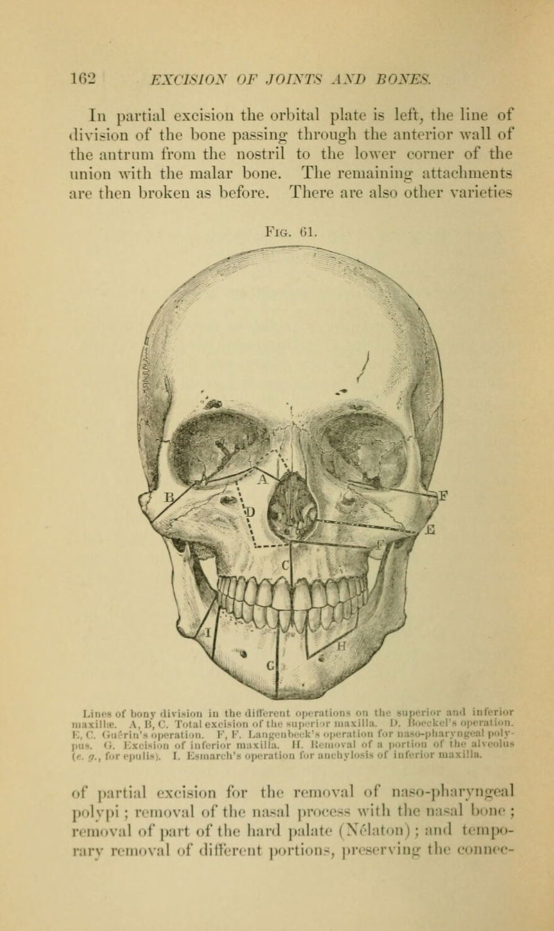 In partial excision the orbital plate is left, the line of division of the bone passing through the anterior wall of the antrum from the nostril to the lower corner of the union with the malar bone. The remaining attachments are then broken as before. There are also other varieties Fig. 01. Lines of bony division in the different operations 'i the superior and inferior \ I'..' . [otal excision of the superior maxilla. I>. Meckel's operation. . ri.r- operatl >n. I - I Langenbeck'a operation i'»r naso-pharyngeal poly- Excision mi' Inferior maxilla. II. Removal of a portion of the ■ (• -/., for epulis). I. Esmarch's operation for anchylosis of Inferior maxilla. ..I' partial excision for the removal of naso-pharyngeal polypi; removal of the nasal process with the nasal bone; removal of pari of the hard palate I Nelaton); and tempo- rary removal of different portion-, preserving the connec-