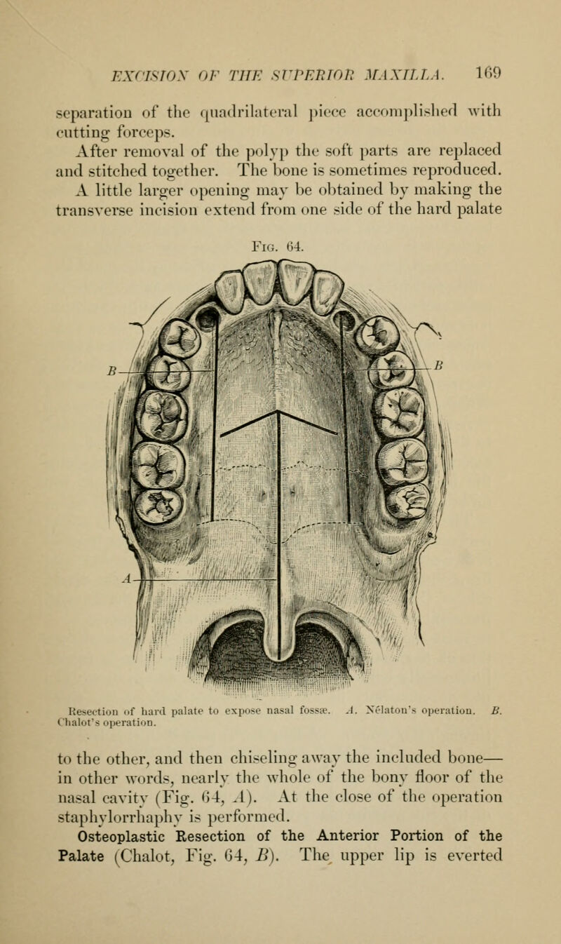 separation of the quadrilateral piece accomplished with cutting forceps. After removal of the polyp the soft parts are replaced and stitched together. The bone is sometimes reproduced. A little larger opening may be obtained by making the transverse incision extend from one side of the hard palate Fig. 64. Resection of hard palate to expose nasal fossae. A. Nelaton's operation. B. Chatot's operation. to the other, and then chiseling away the included bone— in other words, nearly the whole of the bony floor of the nasal cavity (Fig. <!4, .1). At the close of the operation staphylorrhaphy is performed. Osteoplastic Resection of the Anterior Portion of the Palate (Chalot, Fig. 04, B). The upper lip is everted