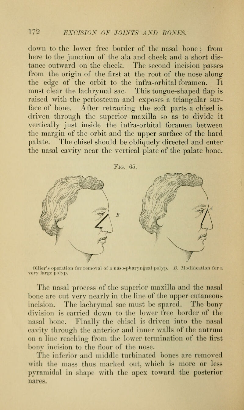down to the lower free border of the nasal bone; from here to the junction of the ala and cheek and a short dis- tance outward on the cheek. The second incision passes from the origin of the first at the root of the nose along the edge of the orbit to the infra-orbital foramen. It must clear the. lachrymal sac. This tongue-shaped flap is raised with the periosteum and exposes a triangular sur- face of bone. After retracting the soft parts a chisel is driven through the superior maxilla so as to divide it vertically just inside the infra-orbital foramen between the margin of the orbit and the upper surface of the hard palate. The chisel should be obliquely directed and enter the nasal cavity near the vertical plate of the palate bone. Fig. 65. Ollier's operation for removal ofa aaso-pharyn&eal polyp, /•'. Mi very large polyp. ilicatioi] for a The nasal process of the superior maxilla and the nasal bone are cut very nearly in the line of the upper cutaneous incision. The lachrymal sac must be spared. The bony division is carried down to the lower free border of the nasal bone. Finally the chisel is driven into the nasal cavity through the anterior and inner walls of the antrum on a line reaching from the lower termination of the first bony incision to the floor of (he nose. The inferior and middle turbinated bones are removed with the mass thus marked out, which is more or less pyramidal in shape with the apex toward the posterior oares.
