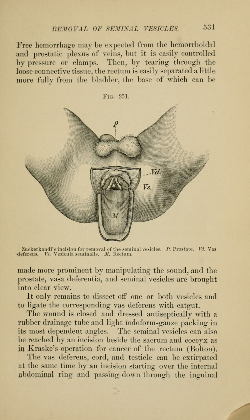 BEMO VA L OF SEMIS. 11 \ rESI( 'L ES. Free hemorrhage may be expected from the hemorrhoidal and prostatic plexus of veins, but it is easily controlled by pressure or clamps. Then, by tearing through tin- loose connective tissue, the rectum is easily separated a little more fully from the bladder, the base of which can be Fig. 261. Zackerkandl's incision for removal of the seminal vesicles. P. Prostate. IV. Vas deferens. Vs. Vesieula seminalis. J/. Rectum. made more prominent by manipulating the sound, and the prostate, vasa deferentia, and seminal vesicles are brought into clear view. It only remains to dissect off one or both vesicles and to ligate the corresponding vas deferens with catgut. The wound is closed and dressed antiseptically with a rubber drainage tube and light iodoforin-gauze packing in its most dependent angles. The seminal vesicles can also be reached by an incision beside the sacrum and coccyx as in Kraske's operation for cancer of the rectum (Bolton). The vas deferens, cord, and testicle can be extirpated at the same time by an incision starting over the internal abdominal ring and passing down through the inguinal