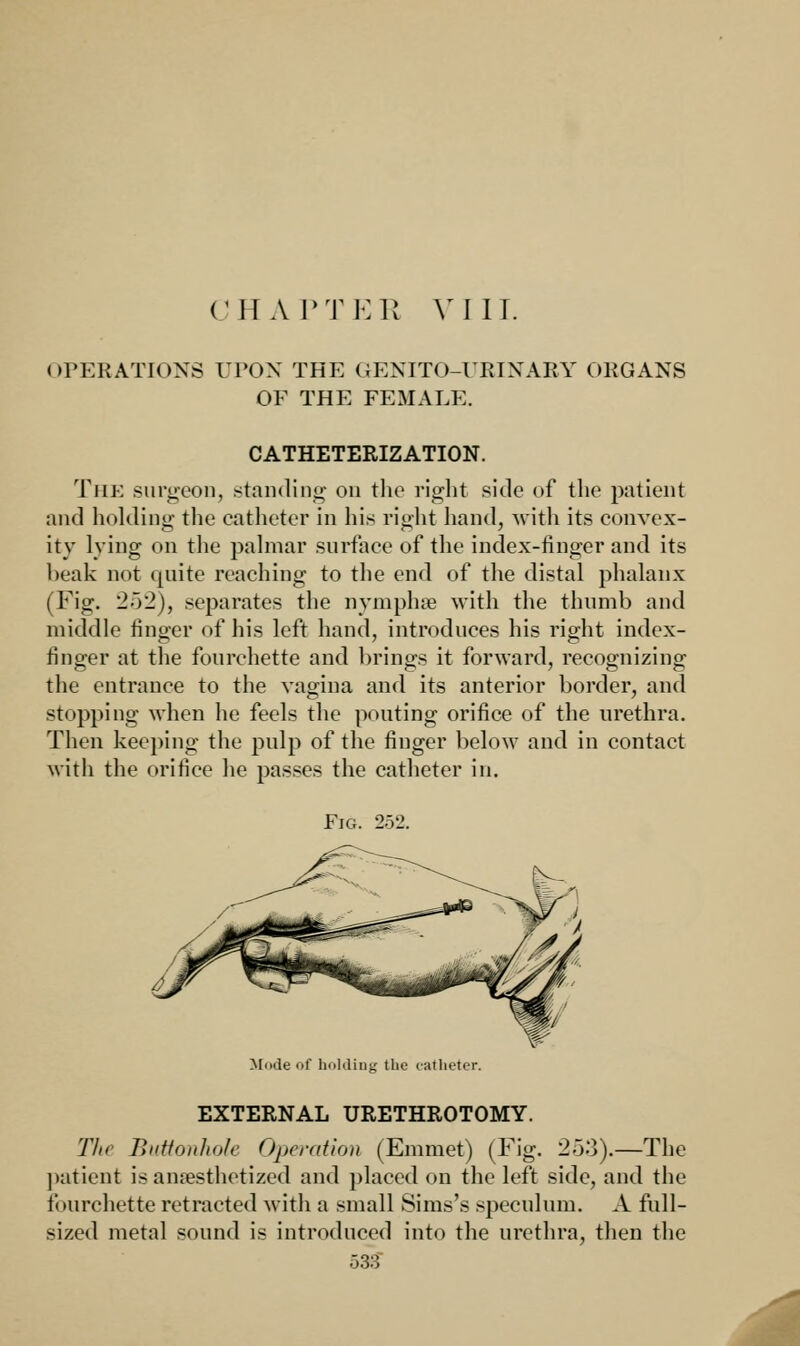 CHA PTER VIII. OPERATIONS UPON THE GENITO-URINARY ORGANS OF THE FEMALE. CATHETERIZATION. The surgeon, standing on the right side of the patient and holding- the catheter in his right hand, with its convex- ity lying on the palmar surface of the index-finger and its beak not quite reaching to the end of the distal phalanx ( Fig. 252), separates the nymphse with the thumb and middle finger of his left hand, introduces his right index- finger at the fourchette and brings it forward, recognizing the entrance to the vagina and its anterior border, and stopping when he feels the pouting orifice of the urethra. Then keeping the pulp of the finger below and in contact with the orifice he passes the catheter in. Fig. 252. Mode of holding the catheter. EXTERNAL URETHROTOMY. The Buttonhole Operation (Emmet) (Fig. 253).—The patient is anaesthetized and placed on the left side, and the fourchette retracted with a small Sims's speculum. A full- sized metal sound is introduced into the urethra, then the