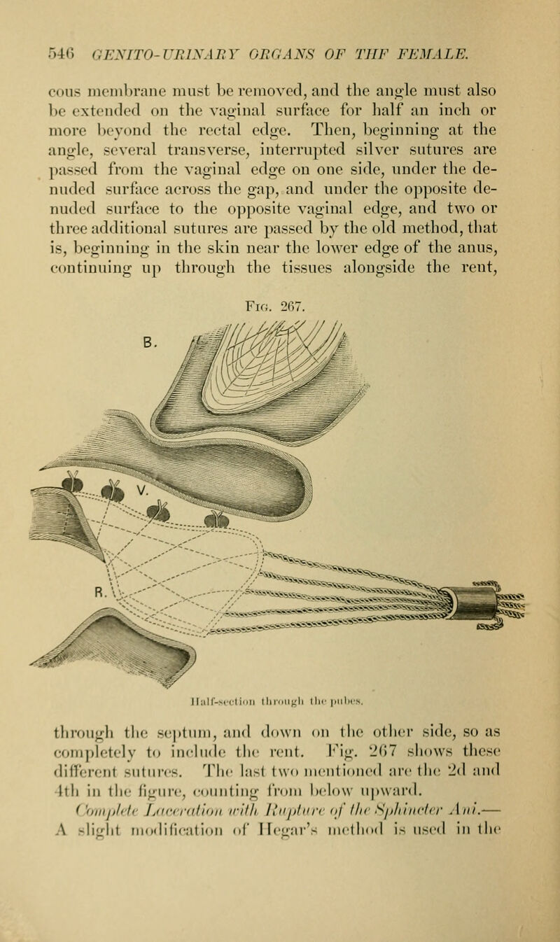 cons membrane must be removed, and the angle must also l>e extended <»n the vaginal surface for half an inch or more beyond the rectal edge. Then, beginning at the angle, several transverse, interrupted silver sutures are passed from the vaginal edge on one side, under the de- nuded surface across the gap, and under the opposite de- nuded surface to the opposite vaginal edge, and two or three additional sutures are passed by the old method, that is, beginning in the skin near the lower edge of the anus, continuing up through the tissues alongside the rent, Fig. 2f>7. ' - ..-.: —* - asssssss Half-section through the pub through tin' septum, and down od the oilier side, so as completely to include the rent. Fig. 267 shows these different sutures. The lasl two mentioned are the 'id and Itli in the figure, counting from below upward. Complete Laceration with Rupture of the Sphincter Ani.— A Blight modification of Heear's method is used in the