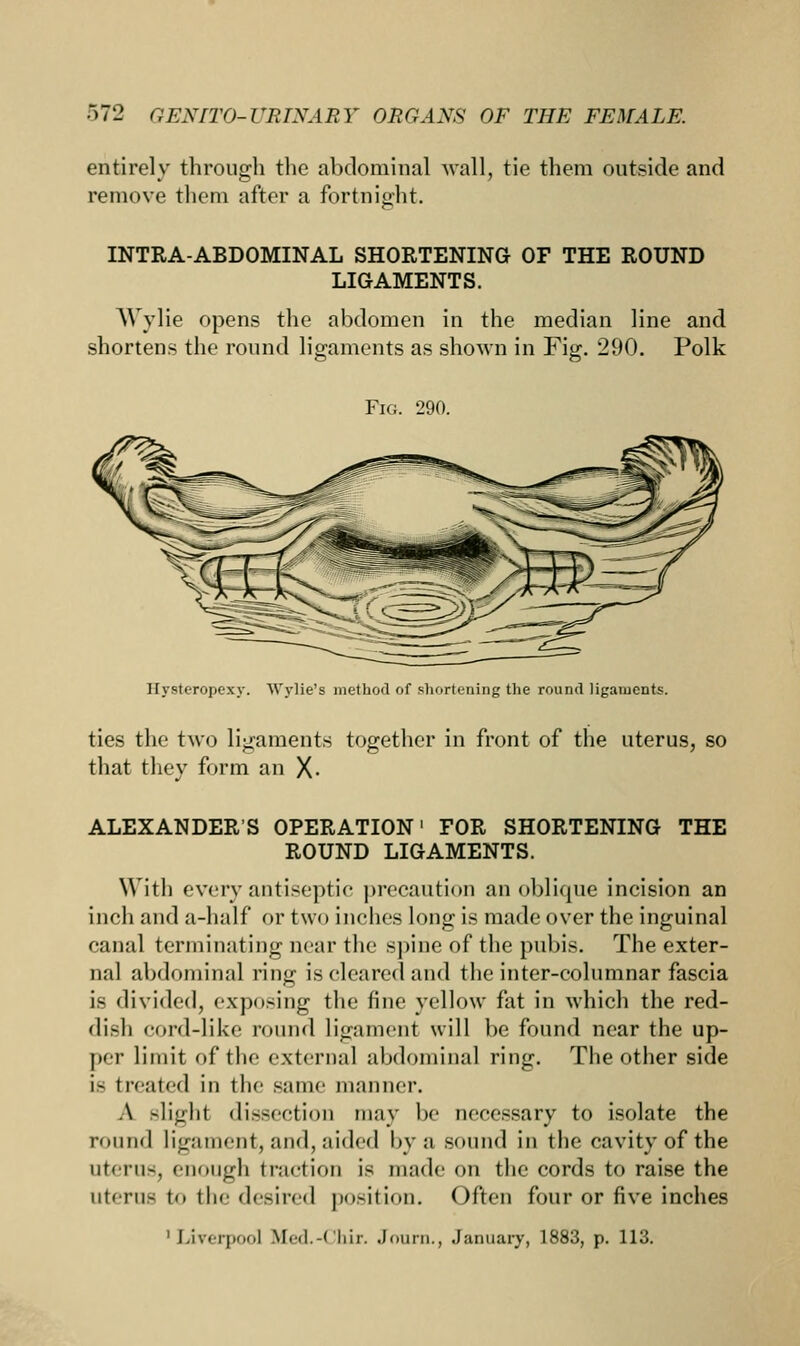 entirely through the abdominal wall, tie them outside and remove them after a fortnight. INTRA-ABDOMINAL SHORTENING OF THE ROUND LIGAMENTS. Wylie opens the abdomen in the median line and shortens the round ligaments as shown in Fig. 290. Polk Fig. 290. Hysteropexy. Wylie's method of shortening the round ligaments. ties the two ligaments together in front of the uterus, so that they form an X- ALEXANDER'S OPERATION1 FOR SHORTENING THE ROUND LIGAMENTS. With every antiseptic precaution an oblique incision an inch and a-half or two inches long is made over the inguinal canal terminating near the spine of the pubis. The exter- nal abdominal ring is cleared and the inter-columnar fascia is divided, exposing the fine yellow fat in which the red- dish cord-like round ligament will be found near the up- per limit of the external abdominal ring. The other side i- treated in the same manner. A -light dissection may be necessary to isolate the round ligament, and, aided by a sound in the cavity of the uterus, enough traction is made on the cords to raise the uterus to the desired position. Often four or five inches 'Liverpool Med.-Chir. Journ., January, 1883, p. 113.