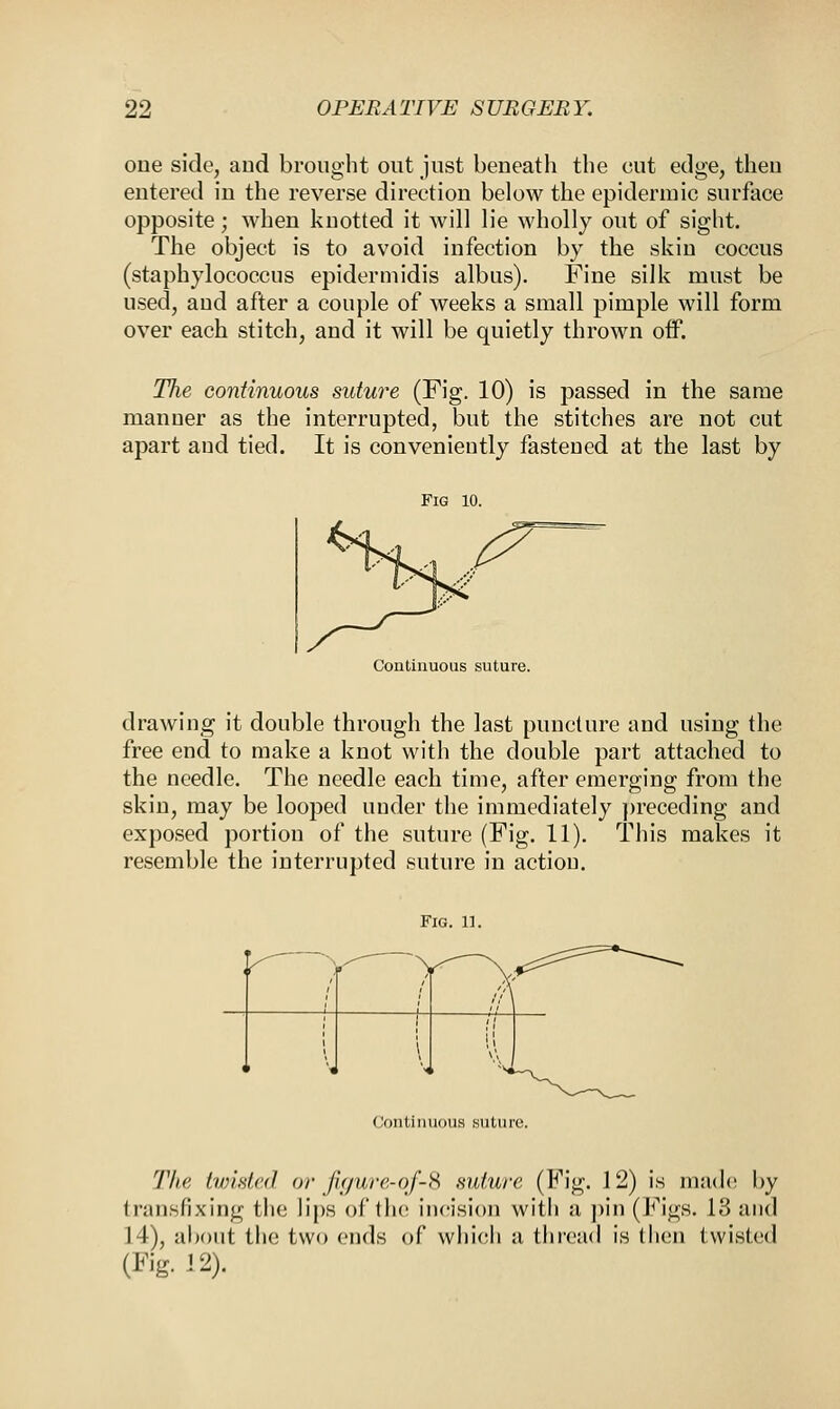 one side, and brought out just beneath the cut edge, then entered in the reverse direction below the epidermic surface opposite; when knotted it will lie wholly out of sight. The object is to avoid infection by the skin coccus (staphylococcus epidermidis albus). Fine silk must be used, aud after a couple of weeks a small pimple will form over each stitch, and it will be quietly thrown off. The continuous suture (Fig. 10) is passed in the same manner as the interrupted, but the stitches are not cut apart and tied. It is conveniently fastened at the last by Fig 10. Continuous suture. drawing it double through the last puncture and using the free end to make a knot with the double part attached to the needle. The needle each time, after emerging from the skin, may be looped under the immediately preceding and exposed portion of the suture (Fig. 11). This makes it resemble the interrupted suture in action. Fig. 11. Continuous suture. The twisted or figure-qf-8 suture (Fig. 12) is made by transfixing the lips of the incision with a pin (Figs. 13 and 14), about the two ends of which a thread is then twisted (Fig. 12).