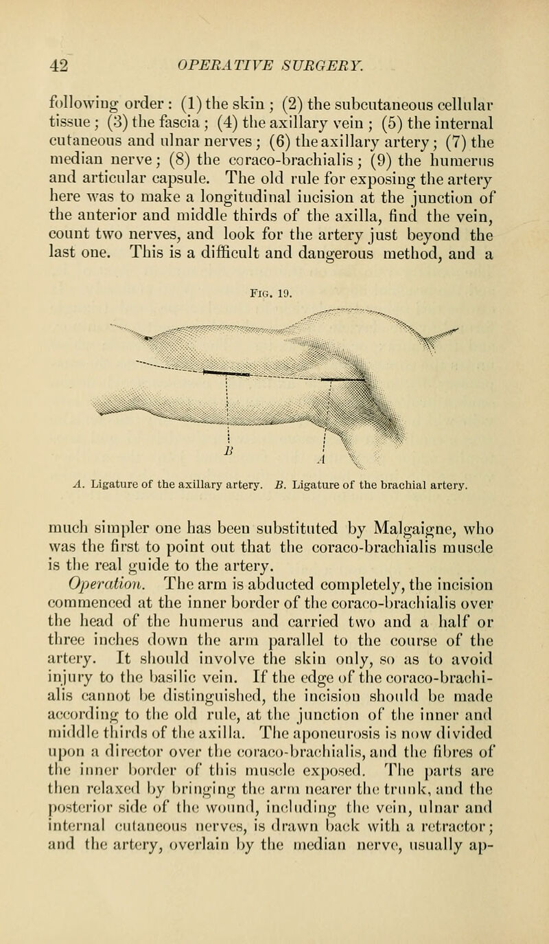 following order : (1) the skin ; (2) the subcutaneous cellular tissue ; (3) the fascia ; (4) the axillary vein ; (5) the internal cutaneous and ulnar nerves; (6) the axillary artery; (7) the median nerve; (8) the coraco-brachialis; (9) the humerus and articular capsule. The old rule for exposing the artery here was to make a longitudinal incision at the junction of the anterior and middle thirds of the axilla, find the vein, count two nerves, and look for the artery just beyond the last one. This is a difficult and dangerous method, and a Fig. 19. H;y' h J A. Ligature of the axillary artery. B. Ligature of the brachial artery. much simpler one has beeu substituted by Malgaignc, who was the first to point out that the coraco-brachialis muscle is the real guide to the artery. Operation. The arm is abducted completely, the incision commenced at the inner border of the coraco-brachialis over the head of the humerus and carried two and a half or three inches down the arm parallel to the course of the artery. It should involve the skin only, so as to avoid injury to the basilic vein. If the edge of the coraco-brachi- alis cannot be distinguished, the incision should be made according to the old rule, at the junction of the inner and middle thirds of the axilla. The aponeurosis is now divided upon a director over the coraco-brachialis,and the fibres of the inner border of this muscle exposed. The parts are then relaxed by bringing the arm nearer the trunk, and the posterior side of the wound, including the vein, ulnar and internal cutaneous nerves, is drawn back with a retractor; and the artery, overlain by the median nerve, usually ap-