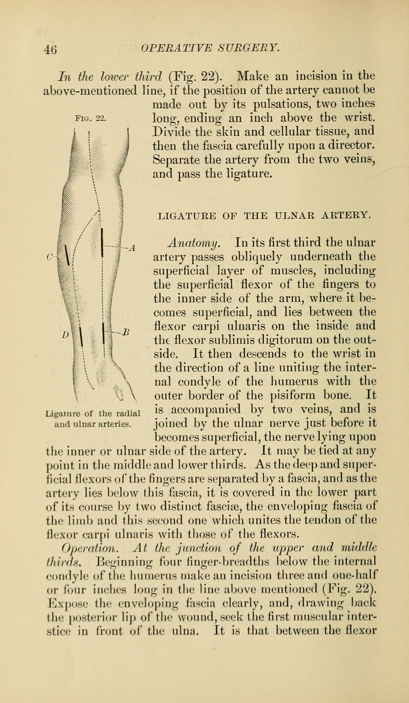 In the lower third (Fig. 22). Make an incision in the above-mentioned line, if the position of the artery cannot be made out by its pulsations, two inches fig. 22. long, ending an inch above the wrist. ! Divide the skin and cellular tissue, and J then the fascia carefully upon a director. i I Separate the artery from the two veins, \ f and pass the ligature. LIGATURE OF THE ULNAR ARTERY. |_A Anatomy. In its first third the ulnar I artery passes obliquely underneath the superficial layer of muscles, including the superficial flexor of the fingers to the inner side of the arm, where it be- comes superficial, and lies between the B flexor carpi ulnaris on the inside aud the flexor sublimis digitorum on the out- I'i If side. It then descends to the wrist in I . the direction of a line uniting the inter- \ \ nal condyle of the humerus with the \ outer border of the pisiform bone. It Ligature of the radial is accompanied by two veins, and is and ulnar arteries. joined by the ulnar nerve just before it becomes superficial, the nerve lying upon the inner or ulnar side of the artery. It may be tied at any point in the middle and lower thirds. As the deep and super- ficial flexors of the fingers are separated by a fascia, and as the artery lies below this fascia, it is covered in the lower part of its course by two distinct fascia?, the enveloping fascia of the limb and this second one which unites the tendon of the flexor carpi ulnaris with those of the flexors. Operation. At the junction of the upper and middle thirds. Beginning four finger-breadths below the internal condyle of the humerus make an incision three and one-half or four indies long in the line above mentioned (Fig. 22). Expose the enveloping fascia clearly, and, drawing back the posterior lip of the wound, seek the first muscular inter- stice in front of the ulna. It is that between the flexor