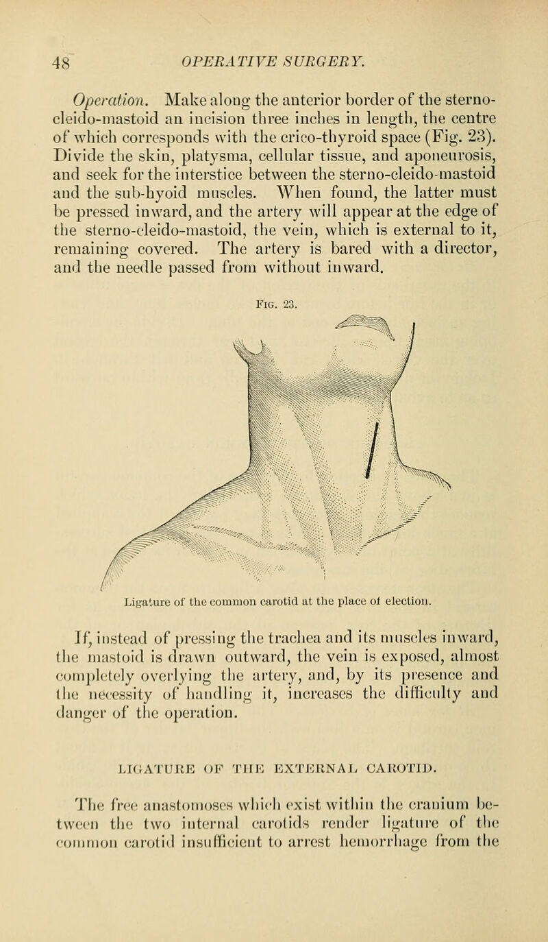 Operation. Make aloug the anterior border of the sterno- cleido-mastoid an incision three inches in length, the centre of which corresponds with the crico-thyroid space (Fig. 23). Divide the skin, platysma, cellular tissue, and aponeurosis, and seek for the interstice between the sterno-cleido-mastoid and the sub-hyoid muscles. When found, the latter must be pressed inward, and the artery will appear at the edge of the sterno-cleido-mastoid, the vein, which is external to it, remaining covered. The artery is bared with a director, and the needle passed from without inward. Fig. 23. Ligature of the common carotid at the place of election. If, instead of pressing the trachea and its muscles inward, the mastoid is drawn outward, the vein is exposed, almost completely overlying the artery, and, by its presence and the necessity of handling it, increases the difficulty and danger of the operation. LIGATURE <>K THE EXTERNAL CAROTID. The free anastomoses which exist within the cranium be- tween the two internal carotids render ligature of the common carotid insufficient to arrest hemorrhage from the