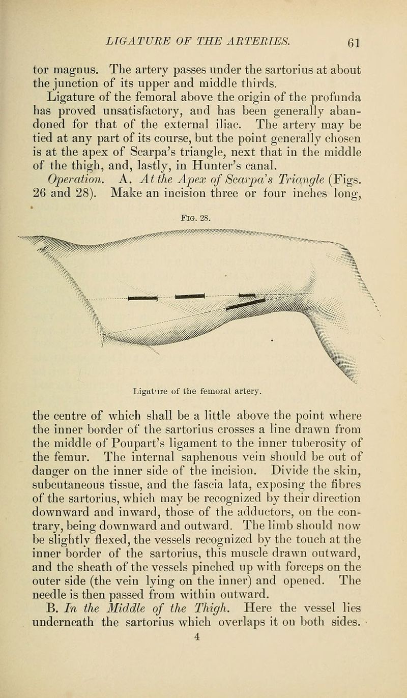 tor magous. The artery passes under the sartorius at about the junction of its upper and middle thirds. Ligature of the femoral above the origin of the profunda has proved unsatisfactory, and has been generally aban- doned for that of the external iliac. The artery may be tied at any part of its course, but the point generally chosen is at the apex of Scarpa's triangle, next that in the middle of the thigh, and, lastly, in Hunter's canal. Operation. A. At the Apex of Scarpa's Triangle (Figs. 26 and 28). Make an incision three or four inches long, .•..•■.•.••■■•••.••''•' Fig. 28. -~. ■m^ Ligature of the femoral artery. the centre of which shall be a little above the point where the inner border of the sartorius crosses a line drawn from the middle of Poupart's ligament to the inner tuberosity of the femur. The internal saphenous vein should be out of danger on the inner side of the incision. Divide the skin, subcutaneous tissue, and the fascia lata, exposing the fibres of the sartorius, which may be recognized by their direction downward and inward, those of the adductors, on the con- trary, being downward and outward. The limb should now be slightly flexed, the vessels recognized by the touch at the inner border of the sartorius, this muscle drawn outward, and the sheath of the vessels pinched up with forceps on the outer side (the vein lying on the inner) and opened. The needle is then passed from within outward. B. In the Middle of the Thigh. Here the vessel lies underneath the sartorius which overlaps it ou both sides.