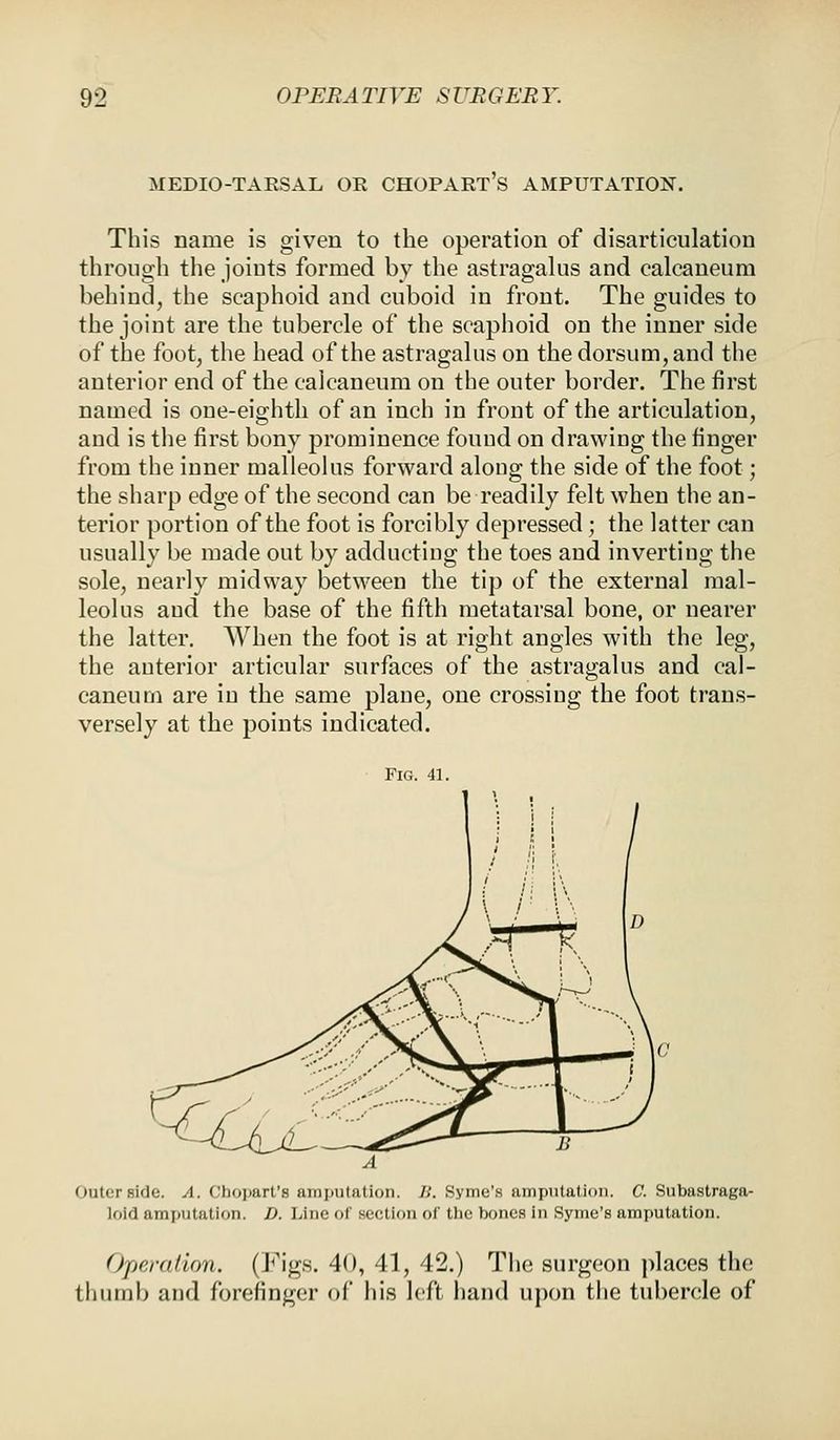 MEDIO-TARSAL OR CHOPART S AMPUTATION. This name is given to the operation of disarticulation through the joints formed by the astragalus and calcaneum behind, the scaphoid and cuboid in front. The guides to the joint are the tubercle of the scaphoid on the inner side of the foot, the head of the astragalus on the dorsum, and the anterior end of the calcaneum on the outer border. The first named is one-eighth of an inch in front of the articulation, and is the first bony prominence found on drawing the finger from the inner malleolus forward along the side of the foot; the sharp edge of the second can be readily felt when the an- terior portion of the foot is forcibly depressed; the latter can usually be made out by adducting the toes and invertiug the sole, nearly midway between the tip of the external mal- leolus and the base of the fifth metatarsal bone, or nearer the latter. When the foot is at right angles with the leg, the anterior articular surfaces of the astragalus and cal- caneum are in the same plane, one crossing the foot trans- versely at the points indicated. Fig. 41. Outer side. A. Choparl's amputation, B. Byrne's amputation. C. Subastraga- loid amputation. D. Line of section of the bones in Syme's amputation. Operation. (Figs. 40, 41, 42.) The surgeon places the thumb and forefinger of his left hand upon the tubercle of