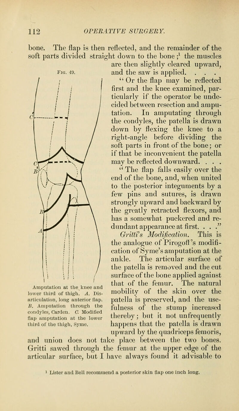 Fig. 49. bone. The flap is then reflected, and the remainder of the soft parts divided straight down to the bone j1 the muscles are then slightly cleared upward, and the saw is applied.  Or the flap may be reflected first and the knee examined, par- ticularly if the operator be unde- cided between resection and ampu- tation. In amputating through the condyles, the patella is drawn down by flexing the knee to a right-angle before dividing the soft parts in front of the bone; or if that be inconvenient the patella may be reflected downward. . . .  The flap falls easily over the end of the bone, and, when united to the posterior integuments by a few pins and sutures, is drawn strongly upward and backward by the greatly retracted flexors, and has a somewhat puckered and re- dundant appearance at first. . . . GritWs Modification. This is the analogue of Pirogoft's modifi- cation of Syme's amputation at the ankle. The articular surface of the patella is removed and the cut surface of the bone applied against that of the femur. The natural mobility of the skin over the patella is preserved, and the use- fulness of the stump increased thereby; but it not unfrequently happens that the patella is drawn upward by the quadriceps femoris, and union does not take place between the two bones. Gritti sawed through the femur at the upper edge of the articular surface, but I have always found it advisable to Amputation at the knee and lower third of thigh. A. Dis- articulation, long anterior flap. B. Amputation through the condyles, Carden. C. Modified flap amputation at the lower third of the thigh, Syme. Lister and Bell recommend a posterior skin flap one inch long.