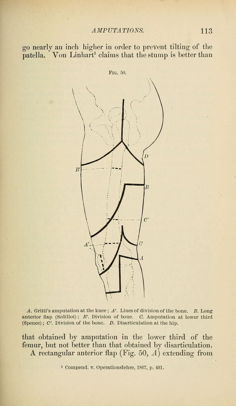go nearly au inch higher in order to prevent tilting of the patella. Von Linhart1 claims that the stump is better than Fig. 50. A. Gritti's amputation at the knee; A'. Lines of division of the bone. B. Long anterior flap (Sedillot); B'. Division of bone. C. Amputation at lower third (Spence); C. Division of the bone. D. Disarticulation at the hip. that obtained by amputation in the lower third of the femur, but not better than that obtained by disarticulation. A rectangular anterior flap (Fig. 50, A) extending from 1 Compend. v. Operationslehre, 1867, p. 401.