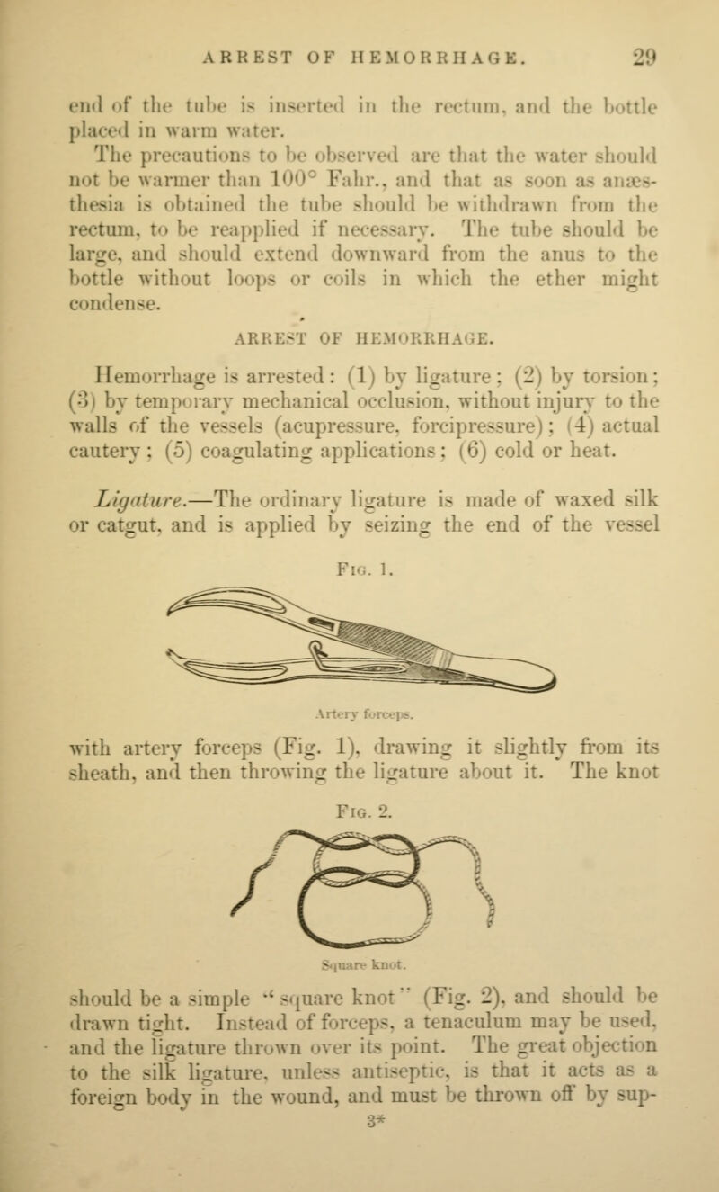 en«l of the tiil»c is insiTtod in the rectum, ami the bottle j)hice«l in warm water. The precautions to be observed are that the water should not be warmer than 100° Fahr., and that as soon as anaes- thesia is obtained the tube should be withdrawn from the rectum, to be reapplied if necessary. The tube should be large, and should extend downward from the anus to the bottle without loops or coils in which the ether might condense. ARREST OF HEMORRHAGE. Hemorrhage is arrested: (1) by ligature; (2) by torsion; (8) by temporary mechanical occlusion, without injury to the walls of the vessels (acupressure, forcipressure); (4) actual cautery ; (5) coagulating applications; (6) cold or heat. Ligature.—The ordinary ligature is made of waxed silk or catgut, and is applied by seizing the end of the vessel Fig. 1. Art«T>- f«»!x>*iiBJ. with artery forceps (Fig. 1), drawing it slightly fi'om its sheath, and then throwing the ligature about it. The knot Fig. 2. S<iuare knot. .should be a simple ** square knot (Fig. 2), and should be drawn tight. Instead of forceps, a tenaculum may be used, and the ligature thrown over its point. The great objection to the silk ligature, unless antiseptic, is that it acts as a foreign body in the wound, and must be thrown off by sup- 3*