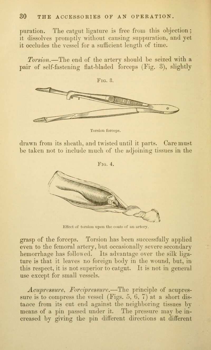 puration. The catgut ligature is free from this objection; it dissolves promptly without causing sujipuration, and yet it occludes the vessel for a sufficient length of time. Torsion.—The end of the artery should be seized with a pair of self-fastening flat-bladed forceps (Fig. 3), slightly Fig. 3. Torsion forceps. drawn from its sheath, and twisted until it parts. Care must be taken not to include much of the adjoining tissues in the Fig. 4. Effect of toreiou upon the coats of au artery. grasp of the forceps. Torsion has been successfully applied even to the femoral artery, but occasionalh severe secondary hemorrhage has followed. Its advantage over the silk liga- ture is that it leaves no foreign body in the wound, but, in this respect, it is not superior to catgut. It is not in general use except for small vessels. Acupressure^ Forcipressure.—The principle of acupres- sure is to compress the vessel (Figs. 5, 6, 7) at a short dis- tance from its cut end against the neighboring tissues by means of a pin passed under it. The pressure may be in- creased by giving the pin different directions at different