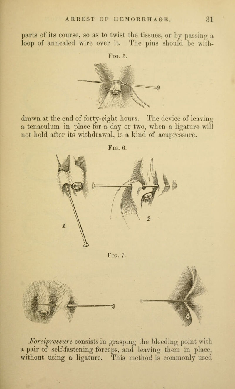 ports of its course, so as to twist the tissues, or by passing' u loop of annealed wire over it. The pins should be with- FiG. 5. -==^ drawn at the end of forty-eight hours. The device of leaving a tenaculum in place for a day or two, when a ligature will not hold after its withdrawal, is a kind of acupressure. Fig. 6. Fig. 7. Forcipressure consists in grasping the bleeding point with a pair of self-fastening forceps, and leaving them in place, without using a ligature. This method is commonly used
