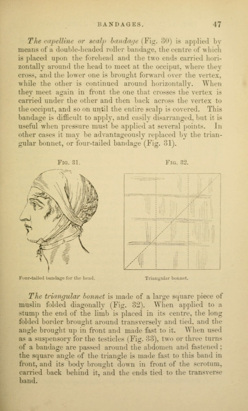The rapelUne or scalp handatje (Fig. 30) is ap|ilie<l bv meiuisof a douMo-lu'aded ioIUt bainlagc. tlie centre <»f which is phice<l upon the torehea<l and tlie two ends c;iiTied liori- zontally around tlie head to meet at the occijmt, where they cross, and the lower one is brought forward over tlie vertex, while tlie otiier is continued amund horizontal!v. When thev meet a-iain in fi'ont the one that crosses the vertex is carried under the other and then back across the vertex to the occiput, and so on until the entire scalp is covered. This bandage is difficult to ap}»ly, and easily disarranged. l)ut it is useftil when pressure must be applied at several jtoints. In other cases it mav be advantacreouslv replaced by the trian- gular bonnet, or four-taileil bandage (Fig. 31). Fig. 32. I Fuar-taile«l Landa^ for the head. ., — ~j 1 ii I! AT^\ TriaDguLir buuuet. Tlie trinngular bonnet is made of a large s«[uare juece of muslin folded diagonally (Fig. 32). When applied to a stump the end of the limb is placed in its centre, the long fohled border brought around transvereely and tied, and the angle brought up in front and made fast to it. When used as a susi»ensory for the testicles (Fig. 33), two or three turns of a bandage are passed around the abdomen and fostened; the square angle of the triangle is made fast to this band in front, and its body l»rought down in front of the scrotum, carried back behind it, and the ends tied to the transverse band.