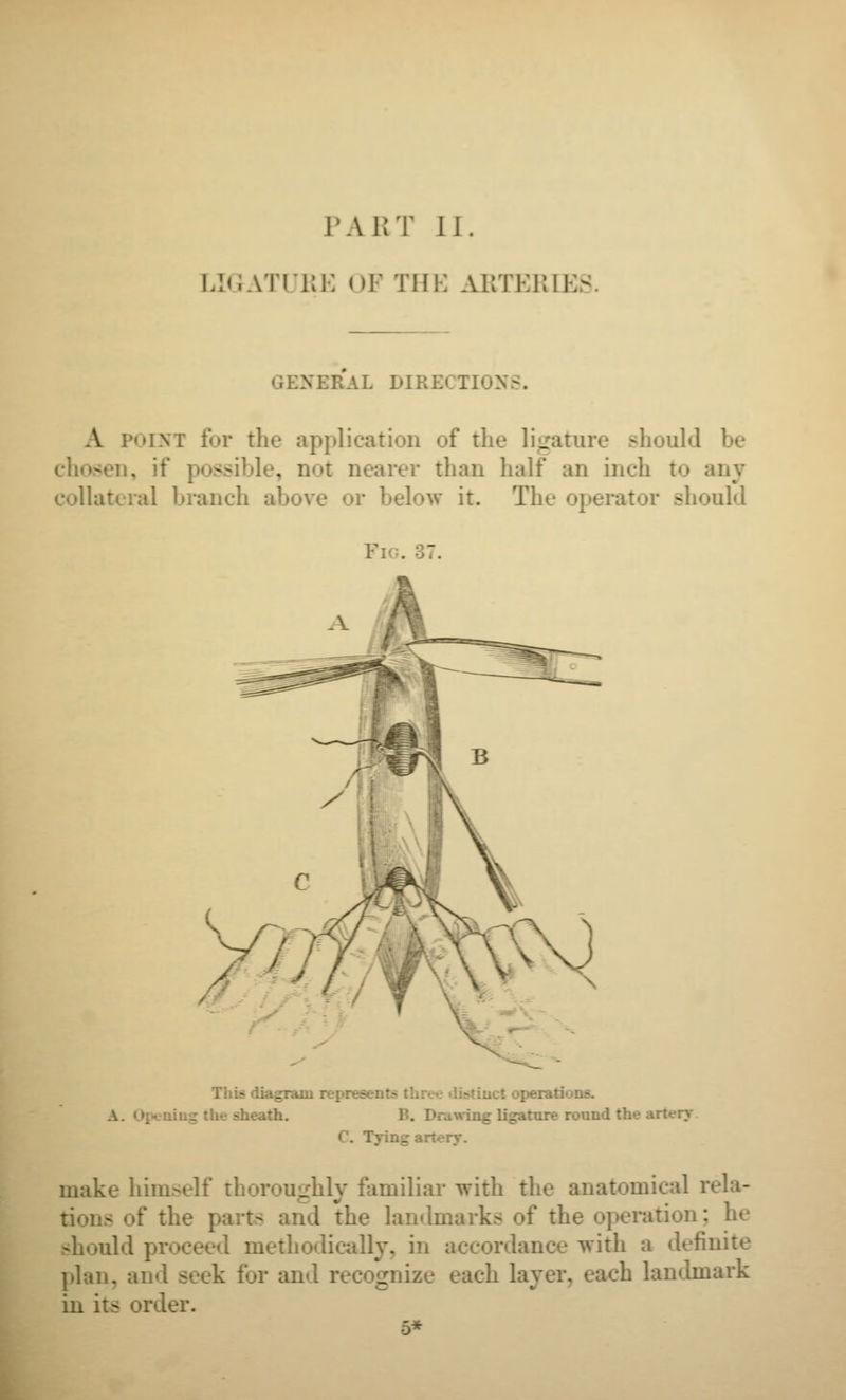 LIGATL'KK OF THK AKTKlilK GENERAL DIRECTIONS. A POINT for the application of the liiiature should be chosen, if possible, not nearer than half an inch to any collateral branch above or below it. The operator should Fig. 37. This diagram represents three ilistiuct operations. A. Opening the sheath. B. Drawing ligature round the artery. C. Tying artery. make him.self thoroughly familiar with the anatomical rela- tions of the parts and the landmarks of the operation; he should proceed methodically, in accordance with a definite plan, and seek for and recognize each layer, each landmark in its order.
