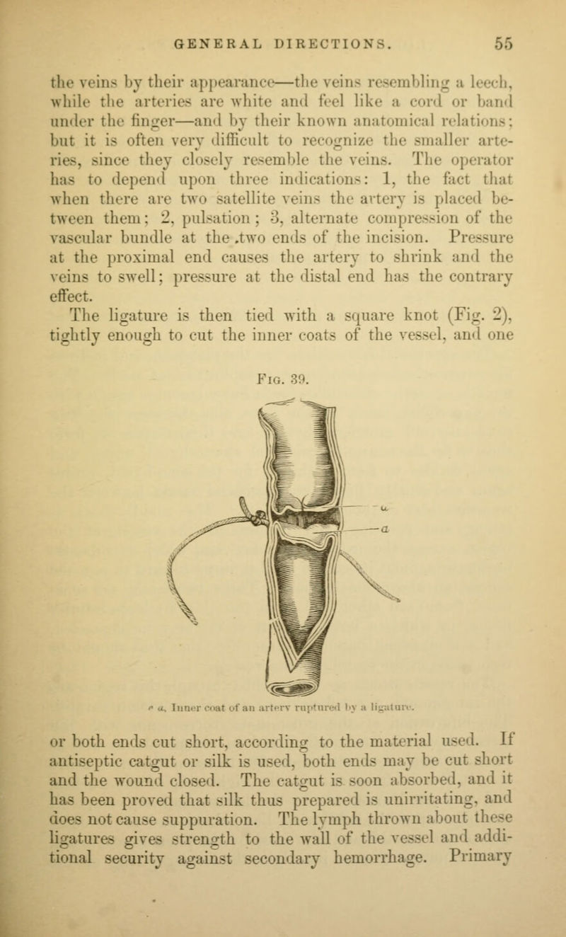 tlio veins by their api)earance—tlie veins resembling a leecli, wliik' tlie arteries are wliite and feel like a conl or ban*! un<ler the finger—and by their known anatomical relations; but it is often very difficult to recojinize the smaller arte- ries, since they closely resemble the veins. The operator has to depend upon three indications: 1, the fact that when there are two satellite veins the artery is placed be- tween them: 2, pulsation ; 3, alternate compression of the vascular bundle at the .two ends of the incision. Pressure at the proximal end causes the artery to shrink and the veins to swell; pressure at the distal end has the contrary effect. The ligature is then tied with a square knot (Fig. 2), tightly enough to cut the inner coats of the vessel, and one Fig. 39. '* a. Tuner c«^t uf an artfrv ruptured l-y a ligaluiv. or both ends cut short, according to the material used. If antiseptic catgut or silk is used, both ends may be cut short and the wound closed. The catgut is soon absorbed, and it has been proved that silk thus prepared is unirritating, and does not cause suppuration. The lymph thrown about these ligatures gives strength to the wall of the vessel and addi- tional security against secondary hemorrhage. Primary