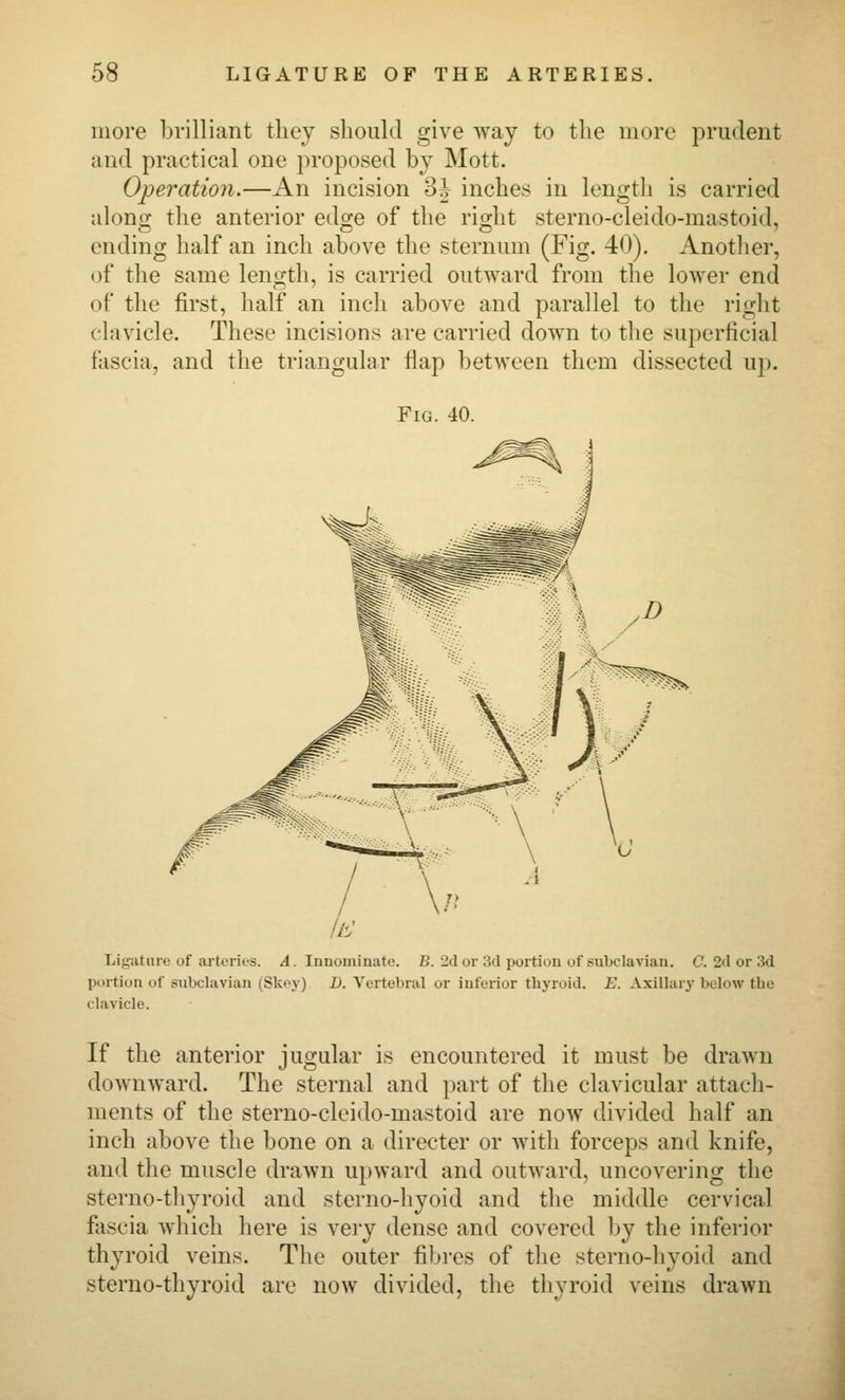 more brilliant they should give Avay to the more j^rudent and practical one proposed by Mott. Operation.—An incision 8J inches in length is carried along the anterior edge of the right sterno-cleido-mastoid, ending half an inch above the sternum (Fig. 40). Another, of the same length, is carried outward from the lower end of the first, half an inch above and parallel to the right clavicle. These incisions are carried down to the superficial fascia, and the triangular flap between them dissected up. Fig. 40. Liyature of arteries. A. Innominate. B. 2cl or 3cl portion of subclavian. C. 2il or 3d portion of subclavian (Skey) D. Vertebral or inferior thyroid. E. Axillary below the clavicle. If the anterior jugular is encountered it must be drawn downward. The sternal and part of the clavicular attach- ments of the sterno-cleido-mastoid are now divided half an inch above the bone on a directer or with forceps and knife, and the muscle drawn upward and outward, uncovering the sterno-thyroid and sterno-hyoid and the middle cervical fascia which here is very dense and covered by the inferior thyroid veins. The outer fibres of the sterno-hyoid and sterno-thyroid are now divided, the thyroid veins drawn