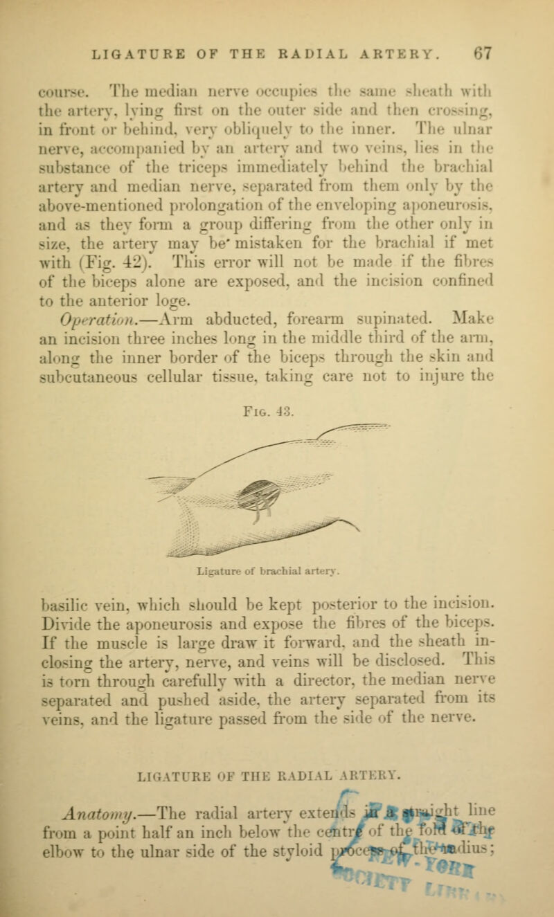 coiii'se. The inudiaii nerve occupies tlie same sheath witli the arterv, l.ving first on the outer side and then crossing, in front or behind, very obliquely to the inner. The ulnar nerve, accompanied by an arterv and two veins, lies in the substance of the triceps immediately behind the brachial arterv and median nerve, separated from them only by the above-mentioned prolongation of the enveloping a})oneun»sis. and as they fonii a group differing from the other only in size, the artery may be' mistaken for the brachial if met with (Fiof. 42). This error will not be made if the fibres of the biceps alone are exposetl. and the incision confined to the anterior loge. Operation.—Arm abducted, forearm supin.ited. Make an incision three inches long in the middle tliird of the ami, along the inner border of the biceps through the skin and subcutaneous cellular tissue, taking care not to injure the Fig. J3. Ligature of brachial artery. basilic vein, which should be kept posterior to the incision. Divide the aponeurosis and expose the fibres of the biceps. If the muscle is large draw it forward, and the sheath in- closing the artery, nerve, and veins will be disclo.«ed. This is torn through carefully with a director, the median nerve separateil and pushed aside, the artery separated fi'om its veins, and the ligature passed fi'om the side of the nerve. LIGATURE OF THE RADIAL ARTERY. Anatomy.—The radial artery extends from a point half an inch below the c^tYt of th| toM «jfhf elbow to the ulnar side of the styloid iyroc^»rf^ft^*»<iius; fj^'