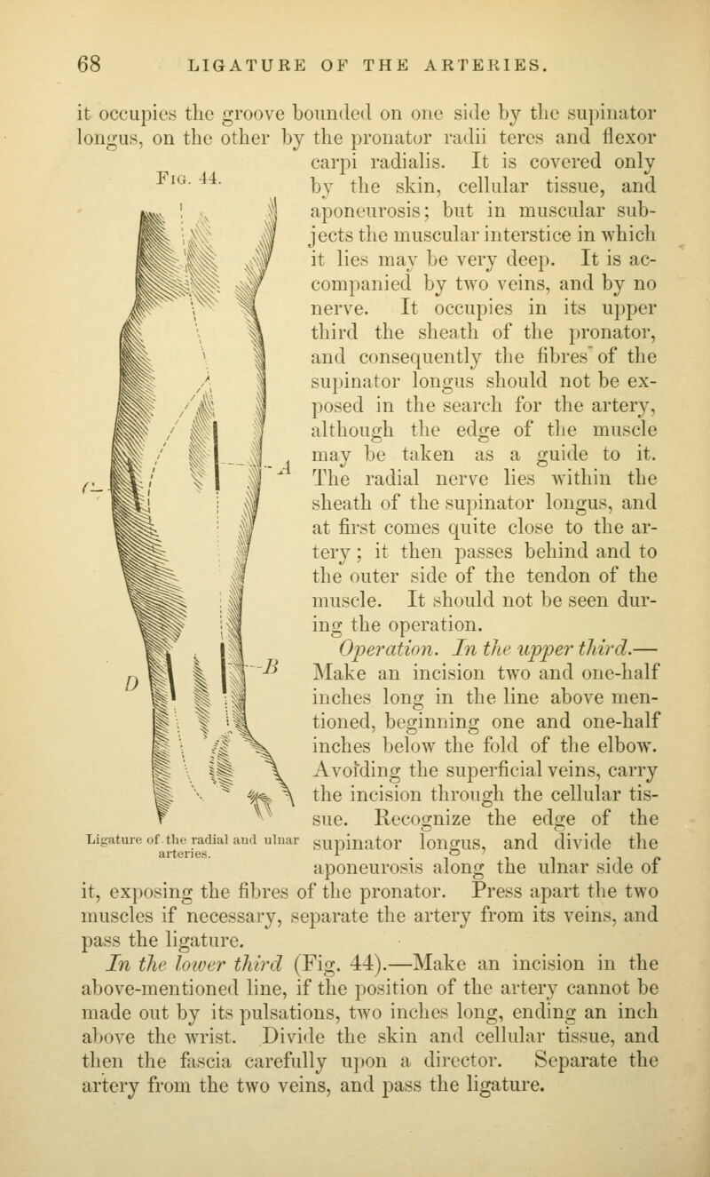 Fig. 44. it occupies the groove bounded on one side by the supinator longus, on the other by the pronator radii teres and flexor carpi radiahs. It is covered only by the skin, cellular tissue, and aponeurosis; but in muscular sub- jects the muscular interstice in which it lies may be very deep. It is ac- companied by two veins, and by no nerve. It occupies in its upper third the sheath of the pronator, and consequently the fibres of the supinator longus should not be ex- posed in the search for the artery, although the edge of the muscle may be taken as a guide to it. The radial nerve lies within the sheath of the supinator longus, and at first comes quite close to the ar- tery ; it then passes behind and to the outer side of the tendon of the muscle. It should not be seen dur- ing the operation. Operation. In the upper third.— Make an incision two and one-half inches long in the line above men- tioned, beginning one and one-half inches below the fold of the elbow. Avoiding the superficial veins, carry the incision through the cellular tis- Recocrnize the edsi-e of the sue. Ligature of the radial aud ulnar arteries. supinator longus. and divide the aponeurosis along the ulnar side of it, exposing the fibres of the pronator. Press apart the two muscles if necessary, separate the artery from its veins, and pass the ligature. In the loioer third (Fig. 44).—Make an incision in the above-mentioned line, if the position of the artery cannot be made out by its pulsations, two inches long, ending an inch a])ove the wrist. Divide the skin and cellular tissue, and then the fascia carefully upon a director. Separate the artery from the two veins, and pass the ligature.
