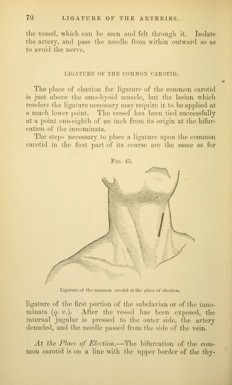 the vessel, wliicli can be seen and felt through it. Isolate the artery, and pass the needle from within outward so as to avoid the nerve. LIGATURE OF THE COMMON CAROTID. The place of election for ligature of the common carotid is just above the omo-hjoid muscle, but the lesion which renders the ligature necessary may require it to be applied at a much lower point. The vessel has been tied successfully at a point one-eighth of an inch from its origin at the bifur- cation of the innominata. The steps necessary to place a ligature upon the common carotid in the first part of its course are the same as for Fig. 45. Ligature of the common carotid at the place of election. ligature of the first portion of the subclavian or of the inno- minata {q. v.). After the vessel has been exposed, the internal jugular is ])ressed to the outer side, the artery denuded, and the needle passed from the side of the vein. At the F J ace of Eh'rtion.—The bifurcation of the com- mon carotid is on a line with the upper border of the thy-