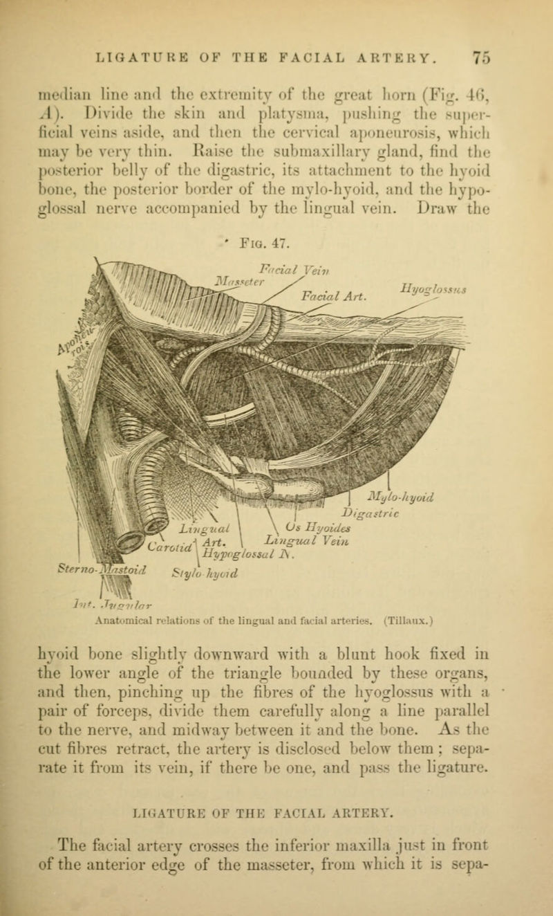 me<lian line ami the extremity of the great liorn (Fig. 46, A). Divide the skin and phitysnia, pushing the super- ficial veins aside, and tlien the cervical a])(>neurosis, which may be very tliin. Raise tlie submaxillary ghmd, find tlic posterior belly of the digastric, its attachment to the hyoid bone, the posterior border of the mylo-hyoid, and the hypo- glossal nerve accompanied by the lingual vein. Draw the ' Fia. 47. r>_ Pucial Veiv 'lllllr^ ■ / Facial Art. Ilyo^lossHS JMylo-hyoid Digastric Us Ilyoidts Anatomical relations of the lingual and facial arteries. (Tillaux.) hyoid bone slightly downward with a blunt hook fixed in the lower angle of the triangle bounded by these organs, and then, pinching up the fibres of the hyoglossus with a pair of forceps, divide them carefully along a line parallel to the nerve, and midway between it and the bone. As the cut fibres retract, the artery is disclosed below them ; sepa- rate it from its vein, if there be one, and pass the ligature. LK4ATURE OF THE FACIAL ARTERY. The facial artery crosses the inferior maxilla just in front of the anterior edge of the masseter, from which it is sepa-