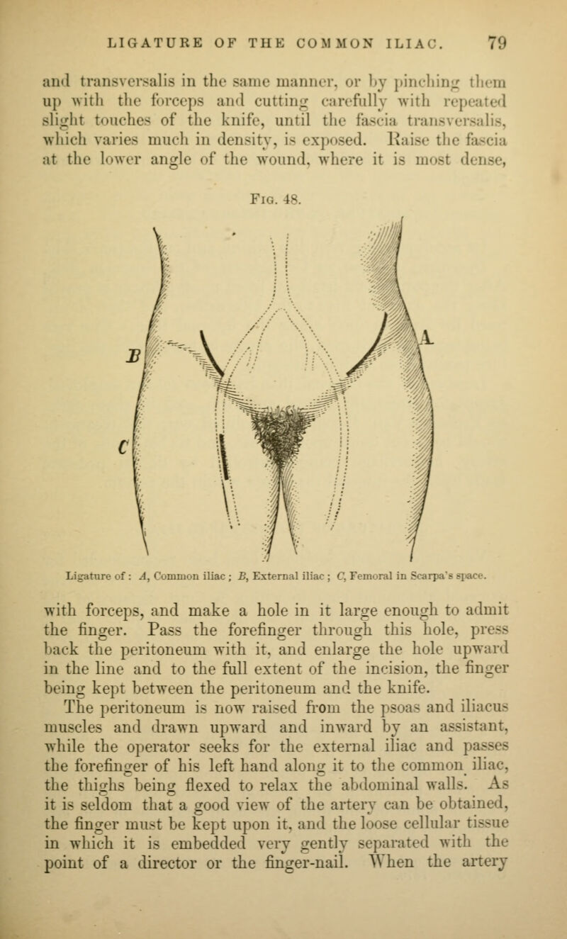 and transvcrsalis in the same manner, or )»v i»incliin<r tliem up Avitli the forceps and cuttin«^ carefully with repeated sli<rht touches of the knife, until the fascia transvcrsalis, which varies much in density, is exposed. Kaise the fascia at the lower angle of the wound, where it is most dense, Fig. 48. Ligature of : A, Common iliac ; B, External iliac ; C, Femoral in Scarpa's space. with forceps, and make a hole in it large enough to admit the finger. Pass the forefinger through this hole, press back the peritoneum with it. and enlarge the hole upward in the line and to the full extent of the incision, the finger being kept between the peritoneum and the knife. The peritoneum is now raised fi'om the psoas and iliacus muscles and drawn upward and inward by an assistant, while the operator seeks for the external iliac and passes the forefinger of his left hand along it to the common iliac, the thighs being flexed to relax the abdominal walls. As it is seldom that a good view of the artery can be obtained, the finger must be kept upon it, and the loose cellular tissue in which it is embedded very gently separated with the point of a director or the finger-nail. When the artery