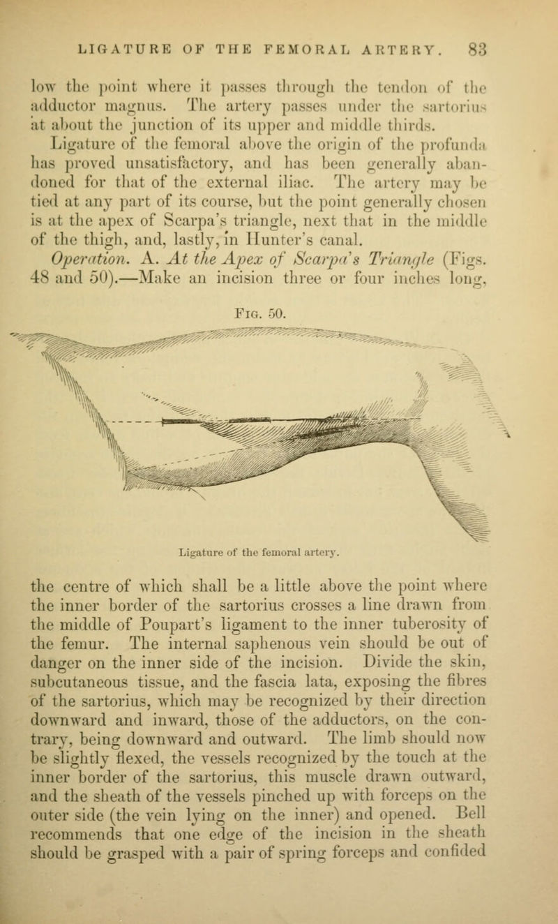 low the j)oiiit where it passes tlirougli tlie tendon of the adductor maii;niis. The artery passes under the sartorius at ahout tlie junction of its upper and ini(hlle thirds. Ligature of the femoral ahove the origin of the pnjfunda has proved unsatisfactory, and has been generally aljan- doned for that of the external iliac. The ai-tery may be tied at any part of its course, but the point generally chosen is at the apex of Scarpa's triangle, next that in the middle of the thigh, and, lastly, in Hunter's canal. Openition. A. At the Apex of Scarp<i's Trian(jJe (Figs. 48 and 50).—Make an incision three or four inches long, '■??^^ ^5=$.^ -^. ^ 1 // ''/'',' m 'C /,;,, i^» ;,- ■J^. wyi^i Ligature of the femoral aitciv. the centre of which shall be a little above tlie point where the inner border of the sartorius crosses a line drawn from the middle of Poupart's ligament to the inner tuberosity of the femur. The internal saphenous vein should be out of danger on the inner side of the incision. Divide the skin, subcutaneous tissue, and the fascia lata, exposing the fibres of the sartorius, which may be recognized by their direction downward and inward, those of the adductors, on the con- trary, being downward and outward. The limb should now be slightly flexed, the vessels recognized by the touch at the inner border of the sartorius, this muscle drawn outward, and the sheath of the vessels pinched up with forceps on the outer side (the vein lying on tlie inner) and opened. Bell recommends that one edge of the incision in the sheath should be grasped with a pair of spring forceps and confided