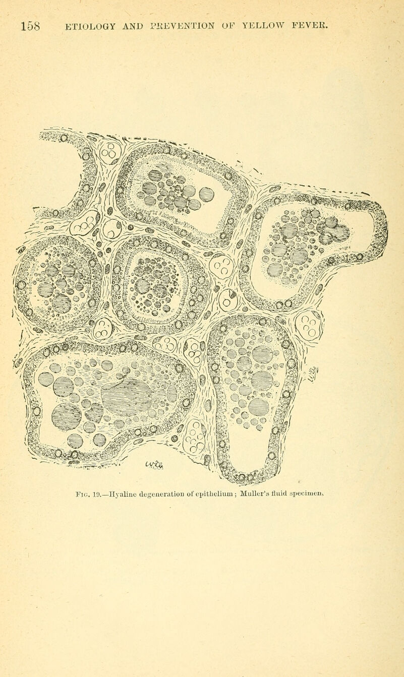 I^enoratiou of epithelium ; Muller's fluid specime^^