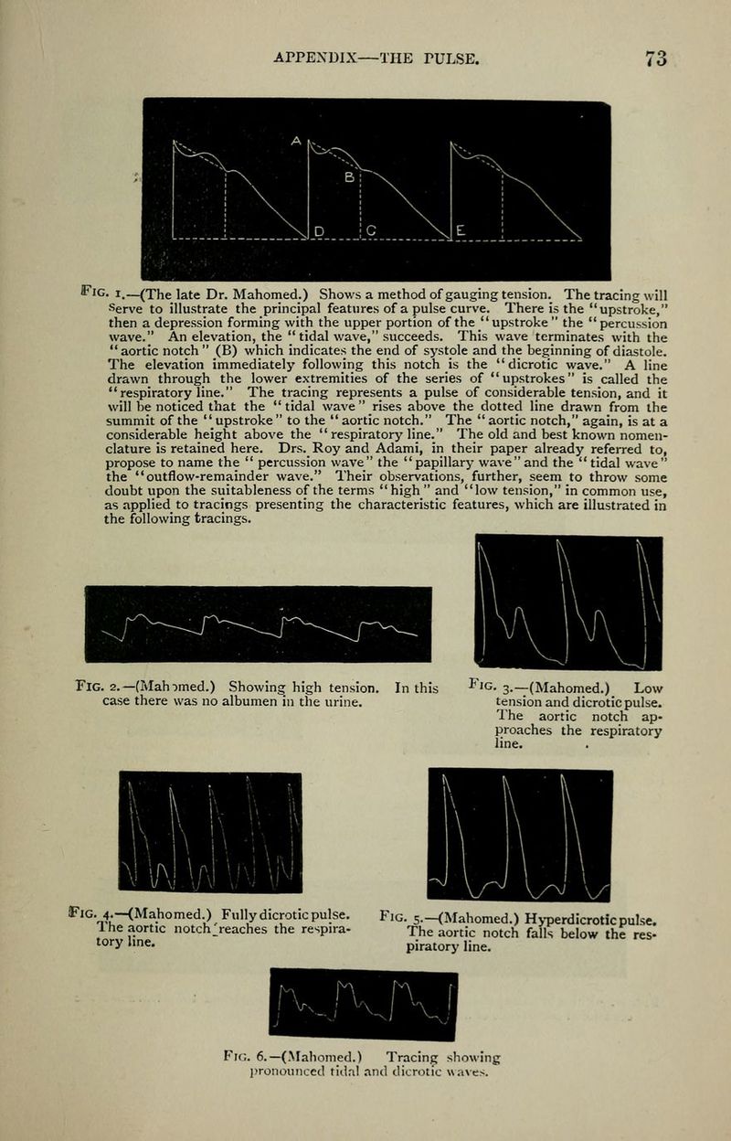 iFiG. I.—(The late Dr. Mahomed.) Shows a method of gauging tension. The tracing will Serve to illustrate the principal features of a pulse curve. There is the upstroke, then a depression forming with the upper portion of the upstroke the percussion wave. An elevation, the tidal wave, succeeds. This wave terminates with the aortic notch (B) which indicates the end of systole and the beginning of diastole. The elevation immediately following this notch is the dicrotic wave. A line drawn through the lower extremities of the series of upstrokes is called the respiratory line. The tracing represents a pulse of considerable tension, and it will be noticed that the tidal wave rises above the dotted line drawn from the summit of the upstroke to the aortic notch. The aortic notch, again, is at a considerable height above the respiratory line. The old and best known nomen- clature is retained here. Drs. Roy and Adami, in their paper already referred to, propose to name the percussion wave the papillary waveand the tidal wave the outflow-remainder wave. Their observations, further, seem to throw some doubt upon the suitableness of the terms high and low tension, in common use, as applied to tracings presenting the characteristic features, which are illustrated in the following tracings. Fig. 2.—(Mahomed.) Showing high tension, case there was no albumen in the urine. In this IiG. 3.—(Mahomed.) Low tension and dicrotic pulse. I'he aortic notch ap- proaches the respiratory line. Fig. 4.—(Mahomed.) Fully dicrotic pulse. The aortic notch^reaches the respira- tory line. F'G. 5.—(Mahomed.) H>-perdicrotic pulse. The aortic notch falls below the res- piratory line. Fir,. 6.—(Mahomed.) Tracing showing l)ronoiinccd tidnl and dicrotic waxes.