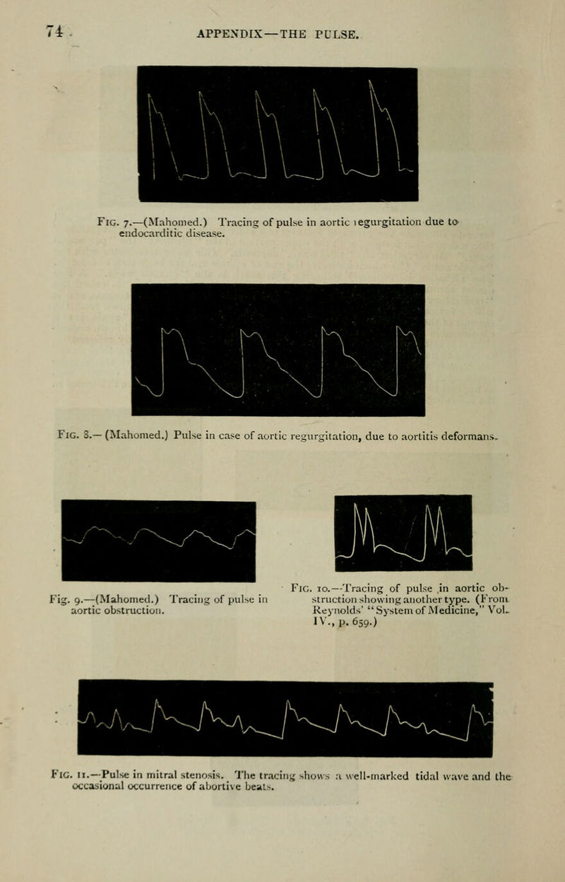 Fig. 7.—(Mahomed.) Tracing of pulse in aortic legurgitation due to endocarditic disease. Fig. 3.— (Mahomed.) Pulse ia case of aortic regurgitation, due to aortitis deformans. Fig. 9.—(Mahomed.) Tracing of pulse in aortic obstruction. FiG. TO.—Tracing of pulse in aortic ob- struction showing another type. (From Reynolds' System of Medicine, VoL IV., p. 659.) Fig. II.—Pulse in mitral stenosis. The tracing shows a well-marked tidal wave and the occasional occurrence of abortive beats.