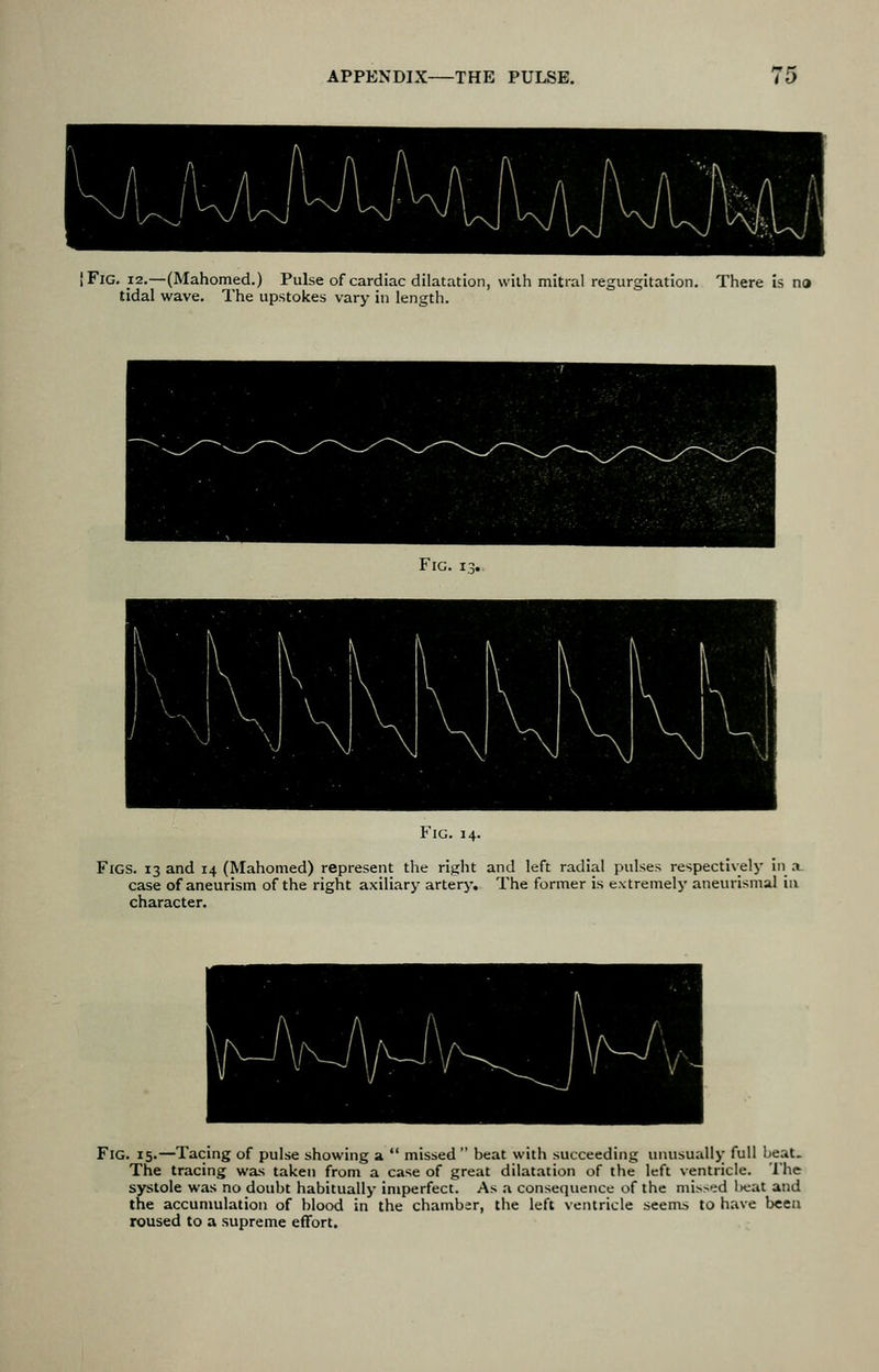 [Fig. 12,—(Mahomed.) Pulse of cardiac dilatation, with mitral regurgitation. There is no tidal wave. The upstokes vary in length. Fig. Fig. 14. Figs. 13 and 14 (Mahomed) represent the right and left radial pulses respectivelj- in a. case of aneurism of the right axiliary artery. The former is extremely aneurismal ia character. Fig. 15.—Tacing of pulse showing a missed beat with succeeding uiiusuallj; full beat. The tracing was taken from a case of great dilatation of the left ventricle. The systole was no doubt habitually imperfect. As a consequence of the missed l)eat and the accumulation of blood in the chamber, the left ventricle seenui to have been roused to a supreme effort.