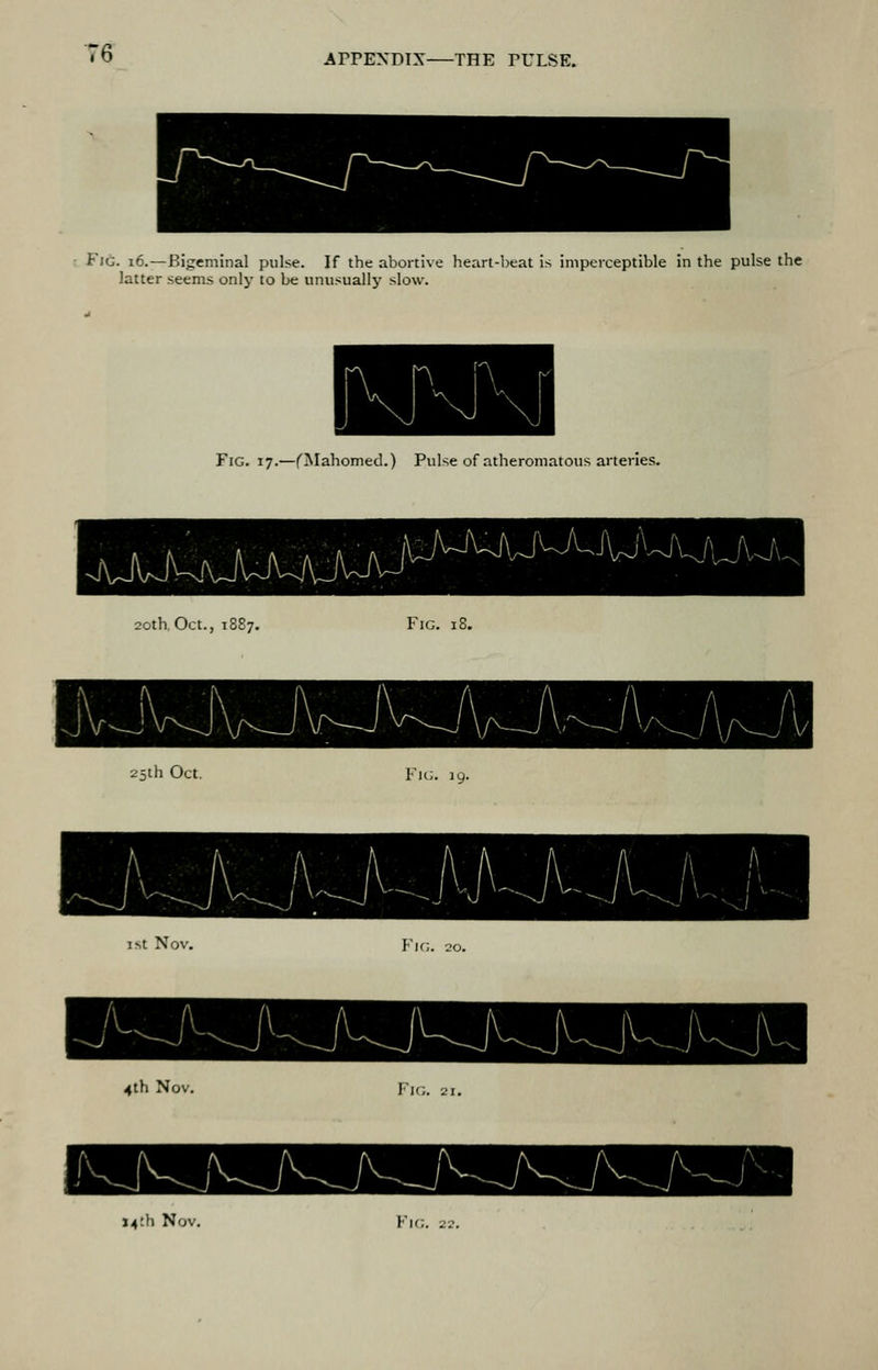 Fjg. i6.—Bigeminal pulse. If the abortive heart-l)eat is imperceptible in the pulse the latter seems only to be unusually slow. Fig. 17.—fMahomed.) Pulse of atheromatous arteries. 20th. Oct., 1887. Fig. 18. 25ih Oct. Fig. 19. 1st Nov. Fig. 20. 4th Nov. Fig. 21.