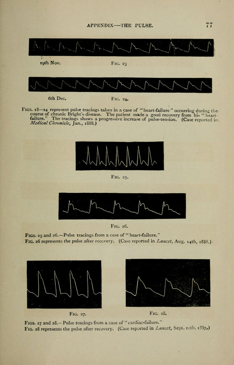 19th Nov. Fig. 6th Dec. Fig. 24. Figs. 18—24 represent pulse tracings taken in a case of heart-failure occurring during the- course of chronic Bright's disease. The patient made a good recovery from his licart- failure. The tracings shows a progressive increase of pulse-tension. (Case reported in Medical Chronicley Jan., 1888.) Fig. Fig. 26. Figs. 25 and 26.—Pulse tracings from a case of heart-failure. Fig. 26 represents the pulse after recovery. (Case reported in Lancet, Aug. 14th, 1886.) Fig. 27. Fig. 28. Figs. 27 and 28.—Pulse tracings from a ca^e of cardiac-failure. Fig. 28 represents the pulse after recovery. (Case reported ill Lancet, Sept. loth, iSS?,)