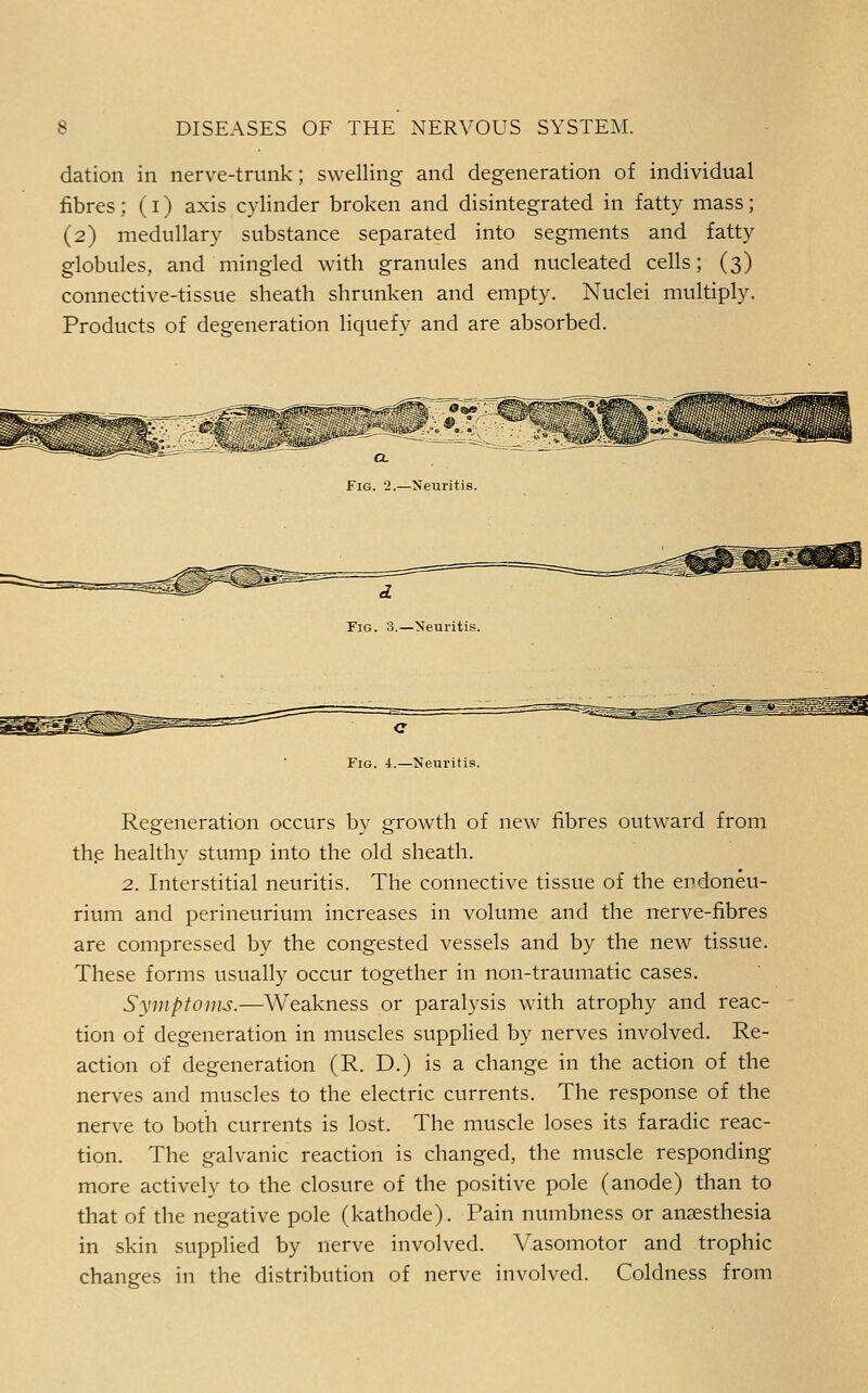 dation in nerve-trunk; swelling and degeneration of individual fibres; (I) axis cylinder broken and disintegrated in fatty mass; (2) medullary substance separated into segments and fatty globules, and mingled with granules and nucleated cells; (3) connective-tissue sheath shrunken and empty. Nuclei multiply. Products of degeneration liquefy and are absorbed. Fig. 2.—Neuritis. Fig. 3.—Neuritis. Fig. 4.—Neuritis. Regeneration occurs by growth of new fibres outward from th.e healthy stump into the old sheath. 2. Interstitial neuritis. The connective tissue of the endoneu- rium and perineurium increases in volume and the nerve-fibres are compressed by the congested vessels and by the new tissue. These forms usually occur together in non-traumatic cases. Syiuptoins.—Weakness or paralysis with atrophy and reac- tion of degeneration in muscles supplied by nerves involved. Re- action of degeneration (R. D.) is a change in the action of the nerves and muscles to the electric currents. The response of the nerve to both currents is lost. The muscle loses its faradic reac- tion. The galvanic reaction is changed, the muscle responding more actively to the closure of the positive pole (anode) than to that of the negative pole (kathode). Pain numbness or anzesthesia in skin supplied by nerve involved. Vasomotor and trophic changes in the distribution of nerve involved. Coldness from