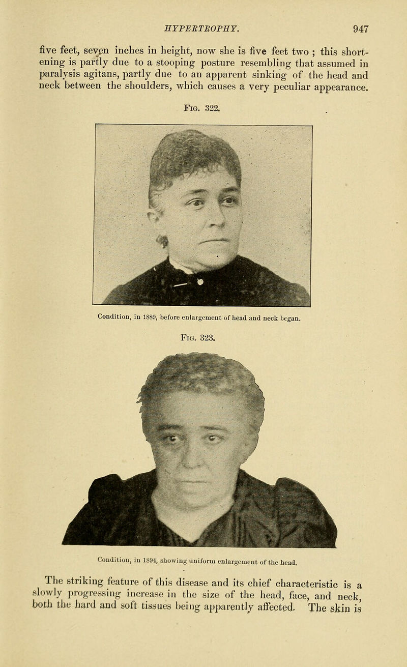 five feet, sevgn inches in height, now she is five feet two ; this short- ening is partly due to a stooping posture resembling that assumed in paralysis agitans, partly due to an apparent sinking of the head and neck between the shoulders, which causes a very peculiar appearance. Fig. 322. Ji-iS* Condition, In 1889, before eulargemeut of head and neck began. Fig. 323. Condition, in 1894, showing uniform enlargement of tlie liead. The striking feature of this disease and its chief characteristic is a slowly progressing increase in the size of the head, face, and neck, both t)je hard and soft tissues being apparently aflfected. The gkin is