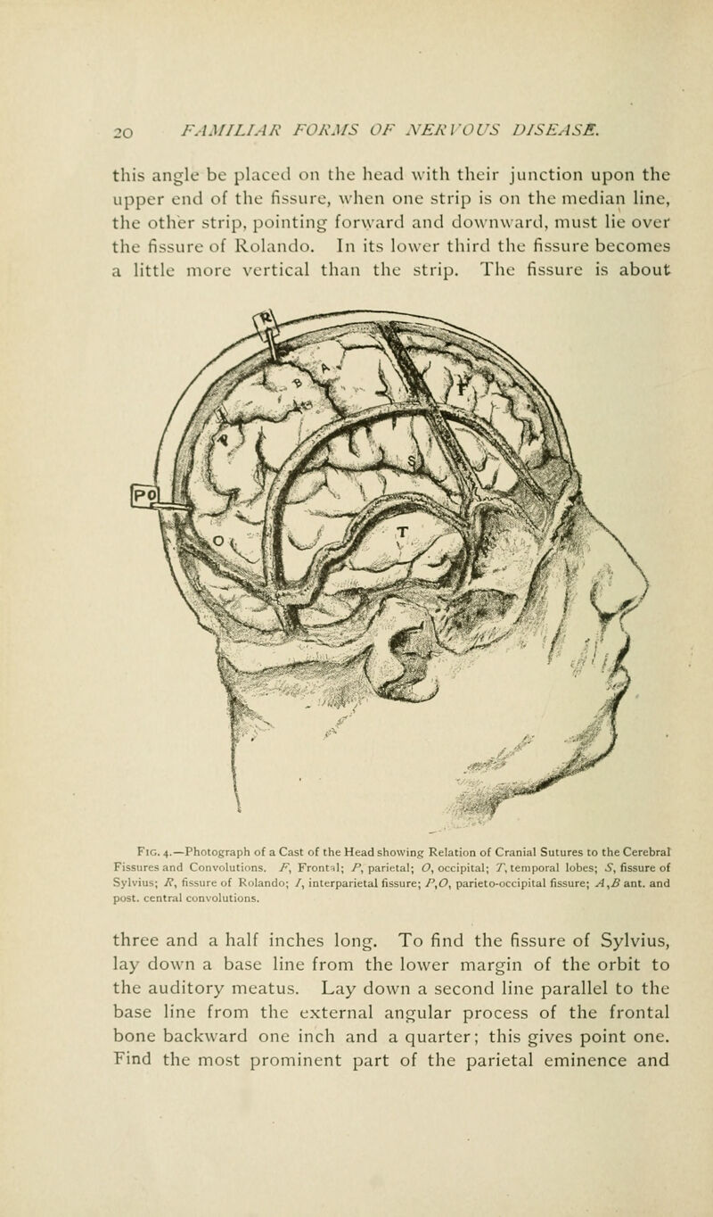 this angle be placed on the head with their junction upon the upper end of the fissure, when one strip is on the median line, the other strip, pointing forward and downward, must lie over the fissure of Rolando. In its lower third the fissure becomes a little more vertical than the strip. The fissure is about Fig. 4.—Photograph of a Cast of the Head showing Relation of Cranial Sutures to the Cerebral Fissures and Convolutions. F, Frontal; /^parietal; O, occipital; T, temporal lobes; S, fissure of Sylvius; /?, fissure of Rolando; /, interparietal fissure; P,0, parieto-occipital fissure; A,B ant. and post, central convolutions. three and a half inches long. To find the fissure of Sylvius, lay down a base line from the lower margin of the orbit to the auditory meatus. Lay down a second line parallel to the base line from the external angular process of the frontal bone backward one inch and a quarter; this gives point one. Find the most prominent part of the parietal eminence and