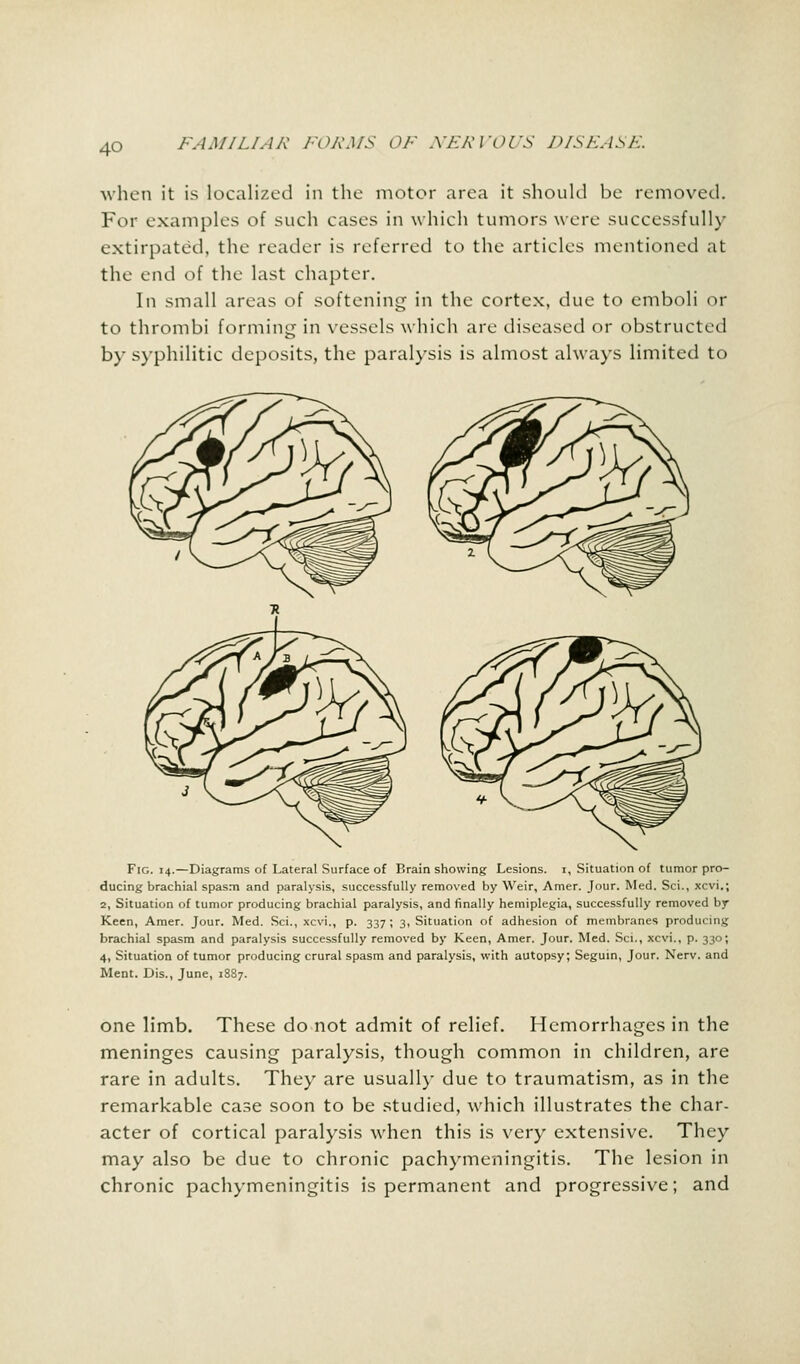 4Q when it is localized in the motor area it should be removed. For examples of such cases in which tumors were successfully extirpated, the reader is referred to the articles mentioned at the end of the last chapter. In small areas of softening in the cortex, due to emboli or to thrombi forming in vessels which are diseased or obstructed by syphilitic deposits, the paralysis is almost always limited to Fig. 14.—Diagrams of Lateral Surface of Brain showing Lesions. 1, Situation of tumor pro- ducing brachial spasm and paralysis, successfully removed by Weir, Amer. Jour. Med. Sci., xcvi.; 2, Situation of tumor producing brachial paralysis, and finally hemiplegia, successfully removed by Keen, Amer. Jour. Med. Sci., xcvi., p. 337 ; 3, Situation of adhesion of membranes producing brachial spasm and paralysis successfully removed by Keen, Amer. Jour. Med. Sci., xcvi., p. 330; 4, Situation of tumor producing crural spasm and paralysis, with autopsy; Seguin, Jour. Nerv. and Ment. Dis., June, 1887. one limb. These do not admit of relief. Hemorrhages in the meninges causing paralysis, though common in children, are rare in adults. They are usually due to traumatism, as in the remarkable case soon to be studied, which illustrates the char- acter of cortical paralysis when this is very extensive. They may also be due to chronic pachymeningitis. The lesion in chronic pachymeningitis is permanent and progressive; and