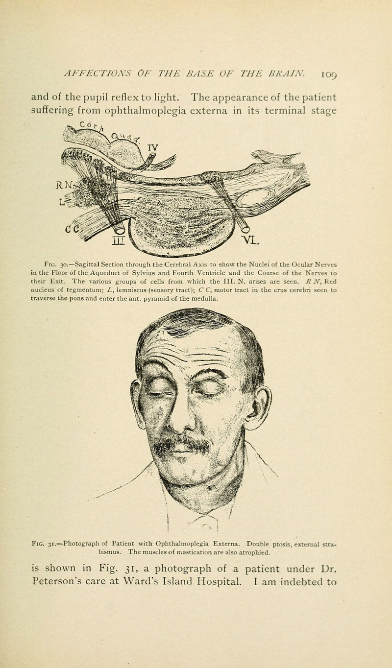 [09 and of the pupil reflex to light. The appearance of the patient suffering from ophthalmoplegia externa in its terminal stage Cdf , Fig. 30.—Sagittal Section through the Cerebral Axis to show the Nuclei of the Ocular Nerves in the Floor of the Aqueduct of Sylvius and Fourth Ventricle and the Course of the Nerves to their Exit. The various groups of cells from which the III. N. arises are seen. R N, Red nucleus of tegmentum; Z,, lemniscus (sensory tract); C C, motor tract in the crus cerebri seen to traverse the pons and enter the ant. pyramid of the medulla. Jw \ - M V Wj 1 Fig. 31.—Photograph of Patient with Ophthalmoplegia Externa. Double ptosis, external stra- bismus. The muscles of mastication are also atrophied. is shown in Fig. 31, a photograph of a patient under Dr. Peterson's care at Ward's Island Hospital. I am indebted to