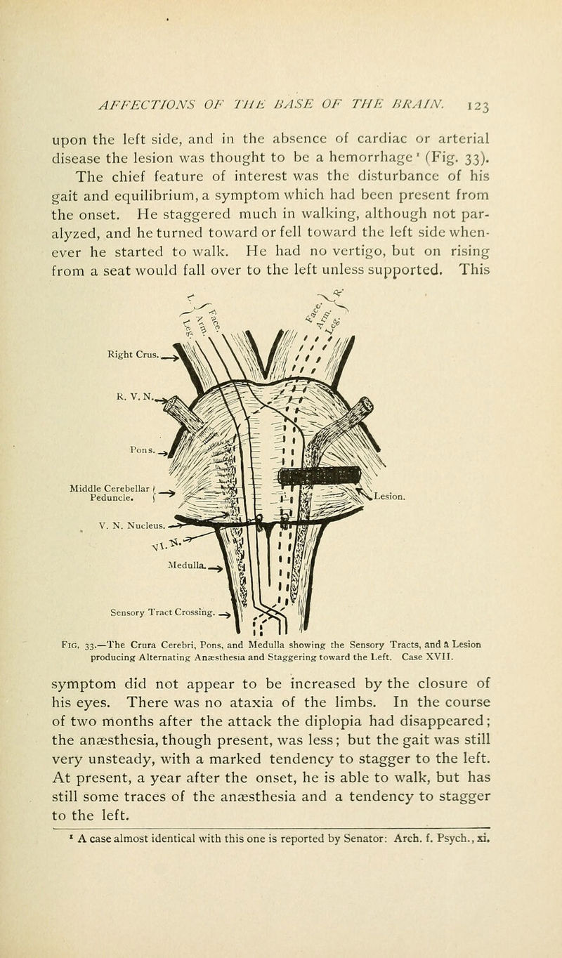 upon the left side, and in the absence of cardiac or arterial disease the lesion was thought to be a hemorrhage' (Fig. 3.3). The chief feature of interest was the disturbance of his gait and equilibrium, a symptom which had been present from the onset. He staggered much in walking, although not par- alyzed, and he turned toward or fell toward the left side when- ever he started to walk. He had no vertigo, but on rising from a seat would fall over to the left unless supported. This Right Cms. R. V. N Pons. Middle Cerebellar I ^' r >^ Peduncle. \ V. N. Nucleus Sensory Tract C Fig, 33.—The Crura Cerebri, Pons, and Medulla showing the Sensory Tracts, and a Lesion producing Alternating Anaesthesia and Staggering toward the Left. Case XVII. symptom did not appear to be increased by the closure of his eyes. There was no ataxia of the limbs. In the course of two months after the attack the diplopia had disappeared; the anaesthesia, though present, was less; but the gait was still very unsteady, with a marked tendency to stagger to the left. At present, a year after the onset, he is able to walk, but has still some traces of the anaesthesia and a tendency to stagger to the left. 1 A case almost identical with this one is reported by Senator: Arch. f. Psych., xi.