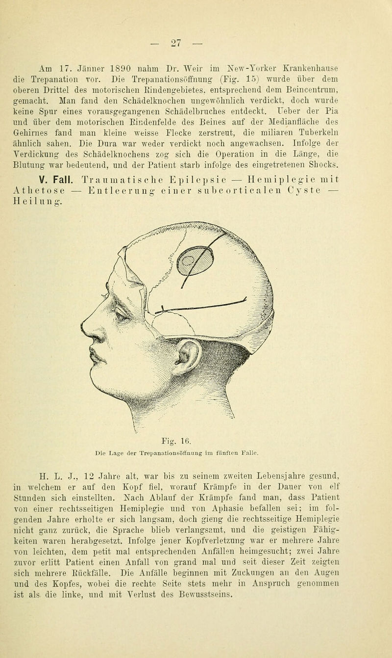 Am 17. Jänner 1890 nahm Dr. Weir im New-Yorker Krankenhause die Trepanation vor. Die Trepanationsöffnung (Fig. 15) wurde über dem oberen Drittel des motorischen Rindengebietes, entsprechend dem Beincentrum, gemacht. Man fand den Schädelknochen ungewöhnlich verdickt, doch wurde keine Spur eines vorausgegangenen Schädelbruches entdeckt. Ueber der Pia und über dem motorischen Eindenfelde des Beines auf der Medianfläche des Gehirnes fand man kleine weisse Flecke zerstreut, die miliaren Tuberkeln ähnlich sahen. Die Dura war weder verdickt noch angewachsen. Infolge der Verdickung des Schädelknochens zog sich die Operation in die Länge, die Blutung war bedeutend, und der Patient starb infolge des eingetretenen Shocks. V. Fall, Traumatische Epilepsie — Hemipleg-ie mit Atlietose — Entleerung- einer subcorticalen Cyste — H e 11 u n «•. Fig. 16. Die Lage der Trepanfitionsöffiiung im fünften Falle. H. L. J., 12 Jahre alt, war bis zu seinem zweiten Lebensjahre gesund, in welchem er auf den Kopf fiel, worauf Krämpfe in der Dauer von elf Stunden sich einstellten. Nach Ablauf der Krämpfe fand man, dass Patient von einer rechtsseitigen Hemiplegie und von Aphasie befallen sei; im fol- genden Jahre erholte er sich langsam, doch gieng die rechtsseitige Hemiplegie nicht ganz zurück, die Sprache blieb verlangsamt, und die geistigen Fähig- keiten waren herabgesetzt. Infolge jener Kopfverletzung war er mehrere Jahre von leichten, dem petit mal entsprechenden Anfällen heimgesucht; zwei Jahre -zuvor erlitt Patient einen Anfall von grand mal und seit dieser Zeit zeigten sich mehrere Rückfälle. Die Anfälle beginnen mit Zuckungen an den Augen und des Kopfes, wobei die rechte Seite stets mehr in Anspruch genommen ist als die linke, und mit Verlust des Bewusstseins.