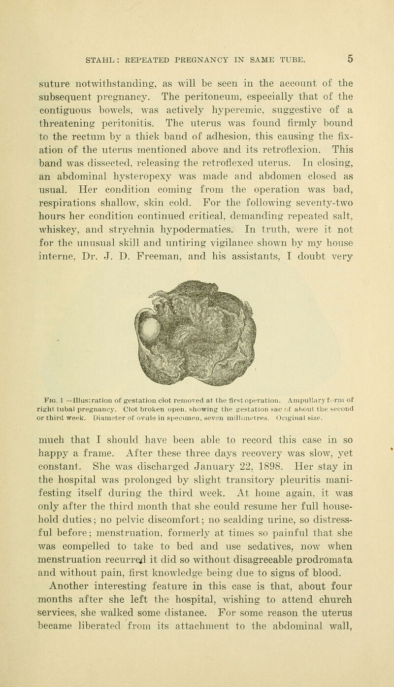 suture notwithstanding, as will be seen in the account of the subsequent pregnancy. The peritoneum, especially that of the contiguous bowels, was actively hyperemic, suggestive of a threatening peritonitis. The uterus was found firmly bound to the rectum by a thick band of adhesion, this causing the fix- ation of the uterus mentioned above and its retroflexion. This band was dissected, releasing the retroflexed uterus. In closing, an abdominal hysteropexy was made and abdomen closed as usual. Her condition coming from the operation was bad, respirations shallow, skin cold. For the following seventy-two hours her condition continued critical, demanding repeated salt, whiskey, and strychnia hypodermatics. In truth, were it not for the unusual skill and untiring vigilance shown by my house interne. Dr. J. D. Freeman, and his assistants, I doubt very Fig. 1 —Illustration of gestation clot removed at the first operation. AmpuUary form of right tubal pregnancy. Clot broken open, showing the gestation sac of about the second or third week. Diameter of ovule in siiecimen, seven millimetres. Original size. much that I should have been able to record this case in so happy a frame. After these three days recovery was slow, yet constant. She was discharged January 22, 1898. Her stay in the hospital was prolonged by slight transitory pleuritis mani- festing itself during the third week. At home again, it was only after the third month that she could resume her full house- hold duties; no pelvic discomfort; no scalding urine, so distress- ful before; menstruation, formerly at times so painful that she was compelled to take to bed and use sedatives, now when menstruation recurred it did so without disagreeable prodromata and without pain, first knowledge being due to signs of blood. Another interesting feature in this case is that, about four months after she left the hospital, wishing to attend church services, she walked some distance. For some reason the uterus became liberated from its attachment to the abdominal wall.