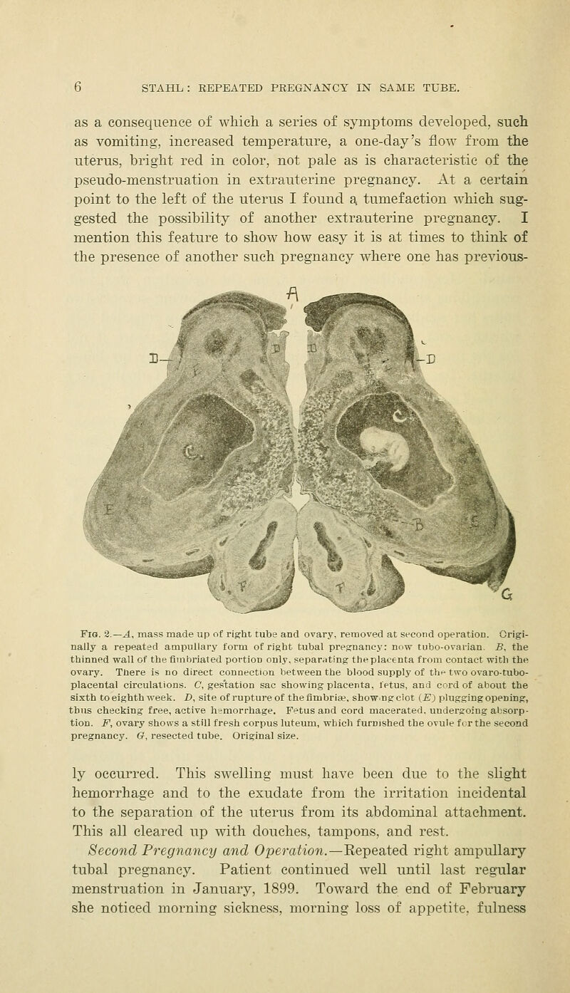 as a consequence of which a series of symptoms developed, such as vomiting, increased temperature, a one-day's flow from the uterus, bright red in color, not pale as is characteristic of the pseudo-menstruation in extrauterine pregnancy. At a certain point to the left of the uterus I found a^ tumefaction which sug- gested the possibility of another extrauterine pregnancy. I mention this feature to show how easy it is at times to think of the presence of another such pregnancy where one has previous- FiG. 2.—A, mass made up of right tube and ovary, removed at second operation. Origi- nally a repeated ampullary form of right tubal pregnancy: now tubo-ovarian. B. the thinned wall of the fimbriated portion only, separating the placenta from contact with the ovary. There is no direct connection between the blood supply of th^ two ovaro-tubo- placental circulations. C, ge.s'tation sac showing placenta, fetus, and cord of about the sixth to eighth week. D, site of rupture of the fimbria?, show.ng clot (E) plugging opening, thus checking free, active hemorrhage. Fetus and cord macerated, undergoing absorp- tion. F, ovary shows a still fresh corpus luteum, which furnished the ovule for the second pregnancy. G, i-esected tube. Original size. ly occurred. This swelling must have been due to the slight hemorrhage and to the exudate from the irritation incidental to the separation of the uterus from its abdominal attachment. This all cleared up with douches, tampons, and rest. Second Pregnancy and Operation.—Repeated right ampullary tubal pregnancy. Patient continued well until last regular menstruation in January, 1899. Toward the end of February she noticed morning sickness, morning loss of appetite, fulness