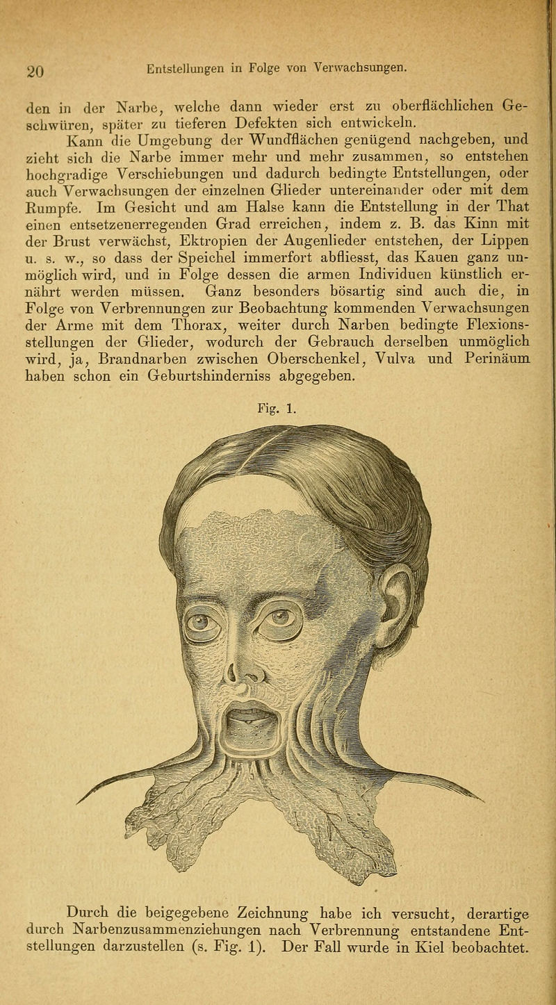 den in der Narbe, welche dann wieder erst zu oberflächlichen Ge- schwüren, später zu tieferen Defekten sich entwickeln. Kann die Umgebung der Wundflächen genügend nachgeben, und zieht sich die Narbe immer mehr und mehr zusammen, so entstehen hochgradige Verschiebungen und dadurch bedingte Entstellungen, oder auch Verwachsungen der einzelnen Glieder untereinander oder mit dem Kumpfe. Im Gesicht und am Halse kann die Entstellung in der That einen entsetzenerregenden Grad erreichen, indem z. B. das Kinn mit der Brust verwächst, Ektropien der Augenlieder entstehen, der Lippen u. s. w., so dass der Speichel immerfort abfliegst, das Kauen ganz un- möglich wird, und in Folge dessen die armen Individuen künstlich er- nährt werden müssen. Ganz besonders bösartig sind auch die, in Folge von Verbrennungen zur Beobachtung kommenden Verwachsungen der Arme mit dem Thorax, weiter durch Narben bedingte Flexions- stellungen der Glieder, wodurch der Gebrauch derselben unmöglich wird, ja, Brandnarben zwischen Oberschenkel, Vulva und Perinäum haben schon ein Geburtshinderniss abgegeben. Fig. 1. i Durch die beigegebene Zeichnung habe ich versucht, derartige durch Narbenzusammenziehungen nach Verbrennung entstandene Ent- stellungen darzustellen (s. Fig. 1). Der Fall wurde in Kiel beobachtet.