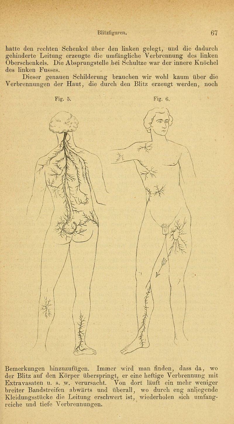 hatte den rechten Schenkel über den linken gelegt, und die dadurch gehinderte Leitung erzeugte die umfängliche Verbrennung des linken Oberschenkels. Die Absprungstelle bei Schnitze war der innere Knöchel des linken Fusses. Dieser genauen Schilderung brauchen wir wohl kaum über die Verbrennungen der Haut, die durch den Blitz erzeugt werden, noch Fig. 5. Fig. 6. Bemerkungen hinzuzufügen. Immer wird man finden, dass da, wo der Blitz auf den Körper überspringt, er eine heftige Verbrennung mit Extravasaten u. s. w. verursacht. Von dort läuft ein mehr weniger breiter Bandstreifen abwärts und überall, wo durch eng anliegende Kleidungsstücke die Leitung erschwert ist, wiederholen sich umfang- reiche und tiefe Verbrennungen.