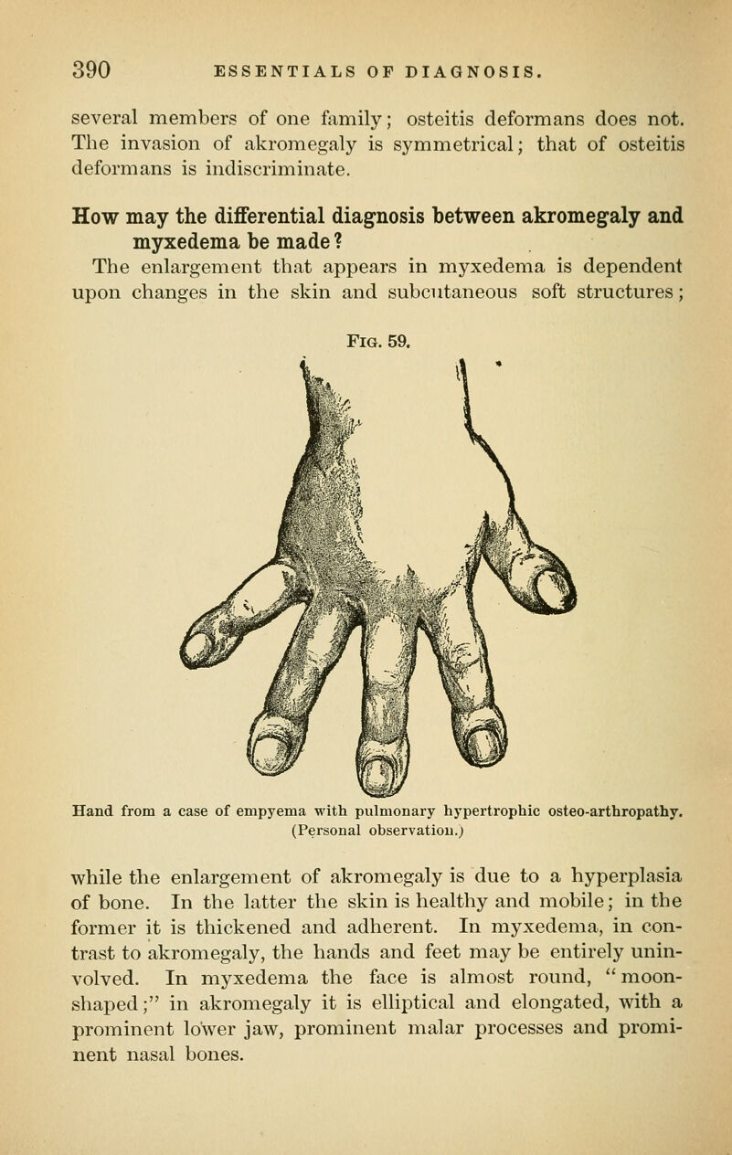 several members of one family; osteitis deformans does not. The invasion of akromegaly is symmetrical; that of osteitis deformans is indiscriminate. How may the differential diagnosis between akromegaly and myxedema be made ? The enlargement that appears in myxedema is dependent upon changes in the skin and subcutaneous soft structures; Fig. 59. Hand from a case of empyema with pulmonary hypertrophic osteo-artbropathy. (Personal observation.) while the enlargement of akromegaly is due to a hyperplasia of bone. In the latter the skin is healthy and mobile; in the former it is thickened and adherent. In myxedema, in con- trast to akromegaly, the hands and feet may be entirely unin- volved. In myxedema the face is almost round,  moon- shaped; in akromegaly it is elliptical and elongated, with a prominent lower jaw, prominent malar processes and promi- nent nasal bones.