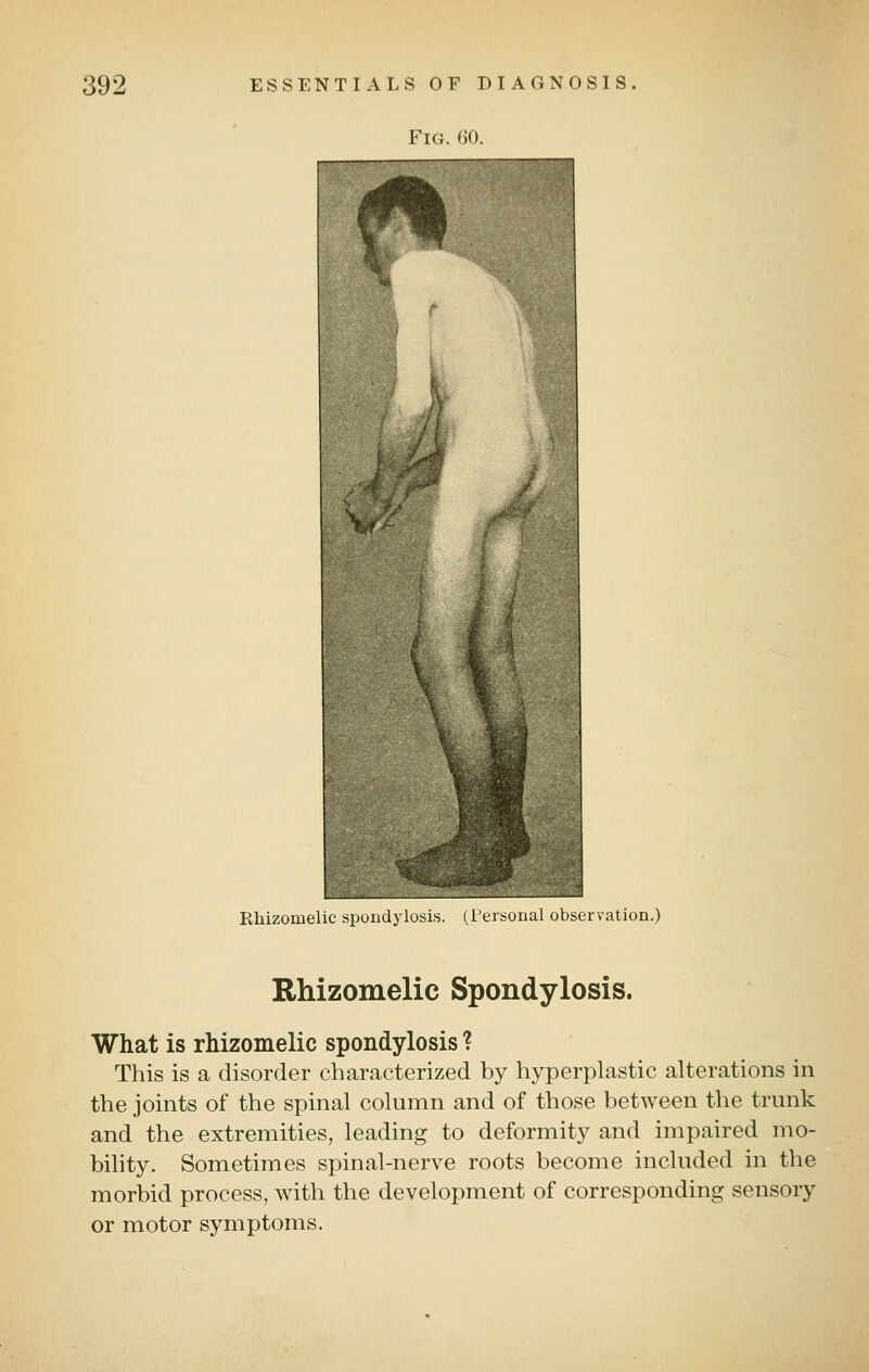 Vu:. (ill. Rhizomelic spondylosis. (Personal observation.) Rhizomelic Spondylosis. What is rhizomelic spondylosis ? This is a disorder characterized by hyperplastic alterations in the joints of the spinal column and of those between the trunk and the extremities, leading to deformity and impaired mo- bility. Sometimes spinal-nerve roots become included in the morbid process, with the development of corresponding sensory or motor symptoms.