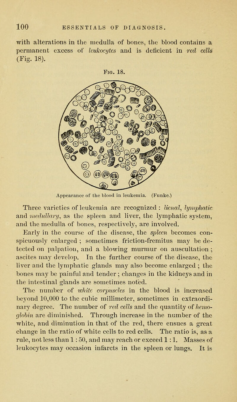 with alterations in the medulla of bones, the blood contains a permanent excess of leukocytes and is deficient in red cells (Fig. 18). Fig. 18. Appearance of the blood in leukemia. (Funke.) Three varieties of leukemia are recognized: Uenal, lyynphatic and raedullary, as the spleen and liver, the lymphatic system, and the medulla of bones, respectively, are involved. Early in the course of the disease, the spleen becomes con- spicuously enlarged ; sometimes friction-fremitus may be de- tected on palpation, and a blowing murmur on auscultation ; ascites may develop. In the further course of the disease, the liver and the lymphatic glands may also become enlarged ; the bones may be painful and tender ; changes in the kidneys and in the intestinal glands are sometimes noted. The number of ivhite corpuscles in the blood is increased beyond 10,000 to the cubic millimeter, sometimes in extraordi- nary degree. The number of red cells and the quantity ofliemo- globin are diminished. Through increase in the number of the white, and diminution in that of the red, there ensues a great change in the ratio of white cells to red cells. The ratio is, as a rule, not less than 1 : 50, and may reach or exceed 1:1. Masses of leukocytes may occasion infarcts in the spleen or lungs. It is